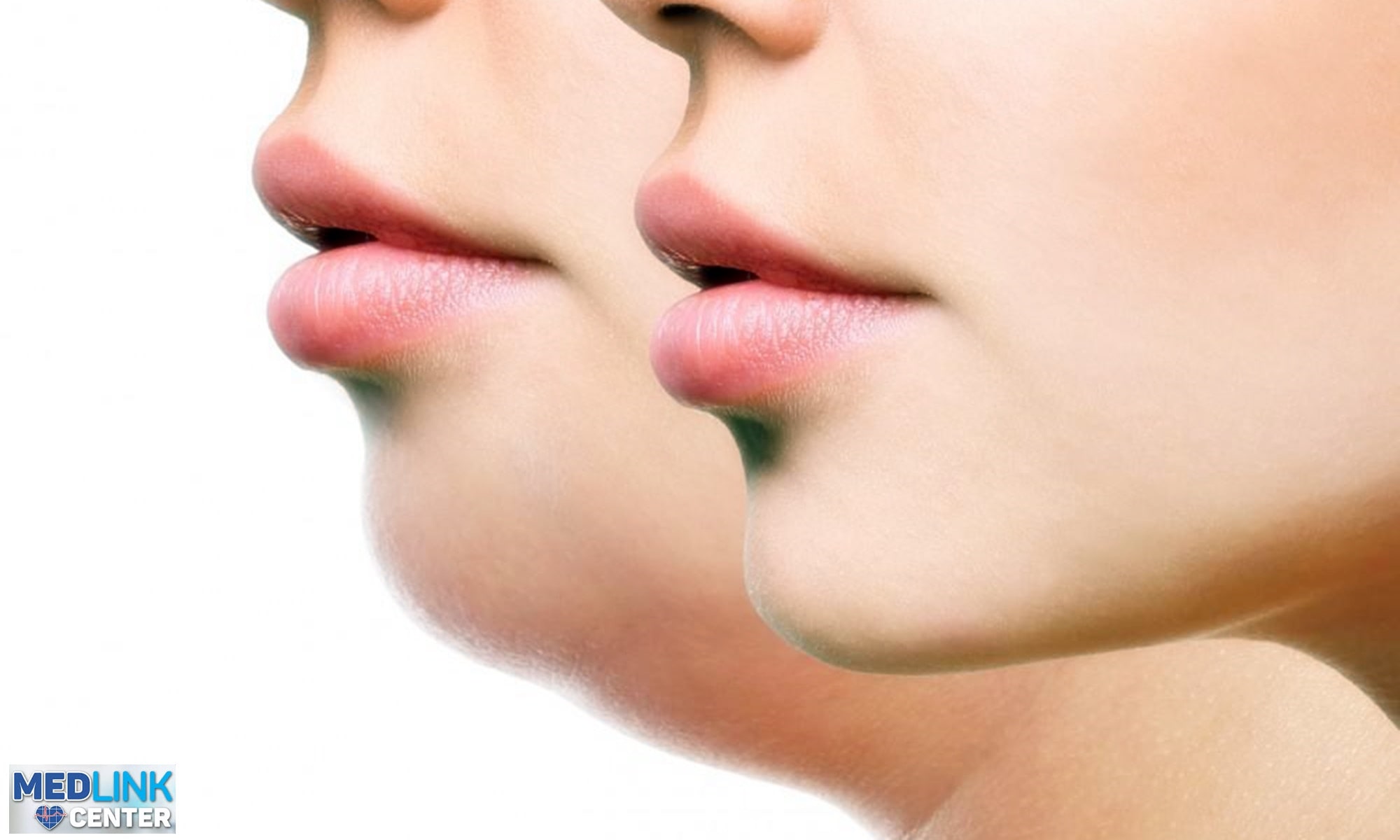 kybella barbie dubla tratament acid clinica medlink craiova