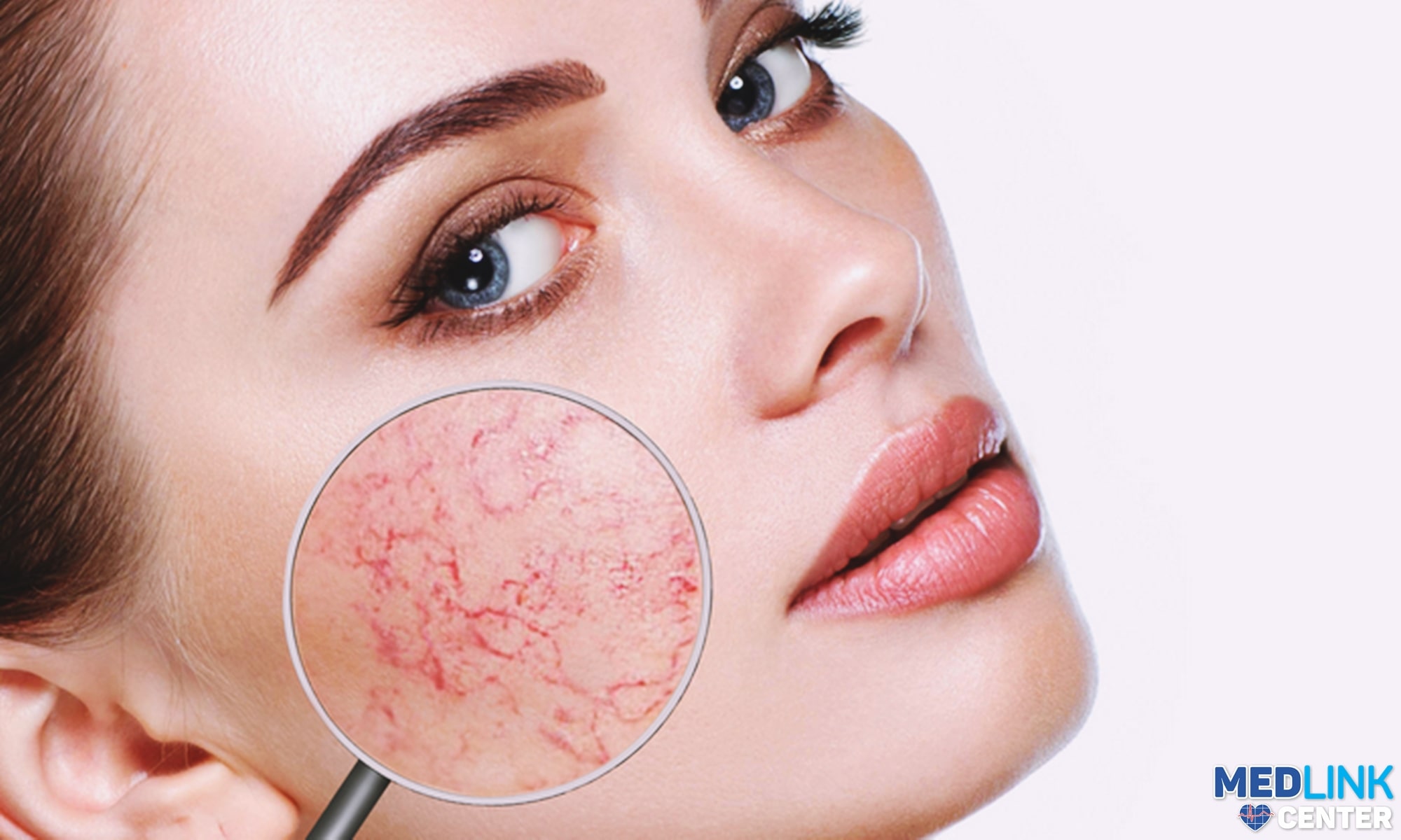 rozaceea dermatologie cauze manifestare tratament clinica medlink craiova rozaceea dermatologie cauze manifestare tratament clinica medlink craiova