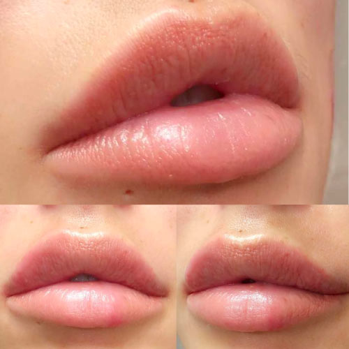 keyhole lips acid hialuronic in buze