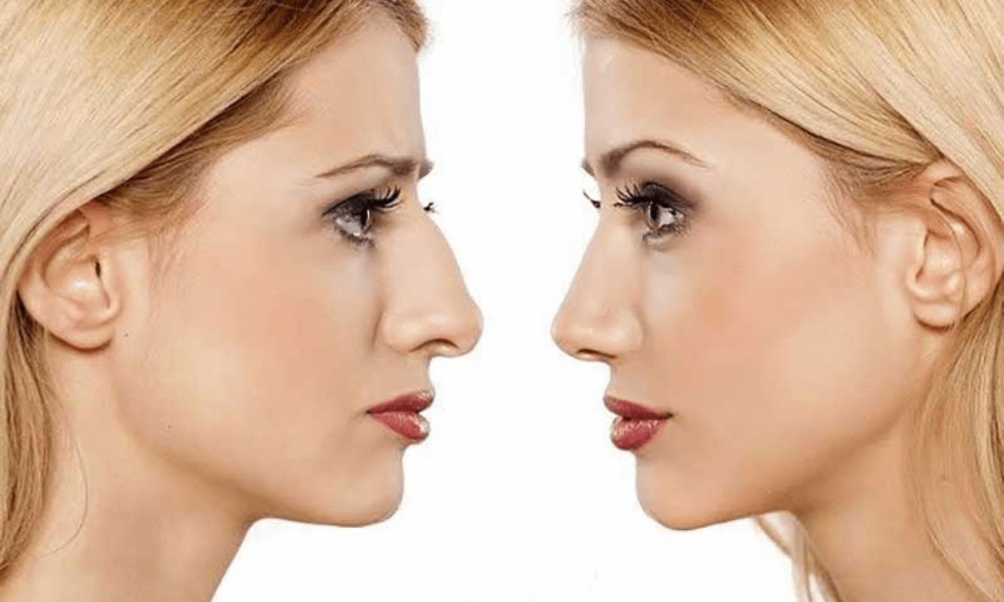 rinoplastie non chirurgicala rinoplastie non chirurgicala