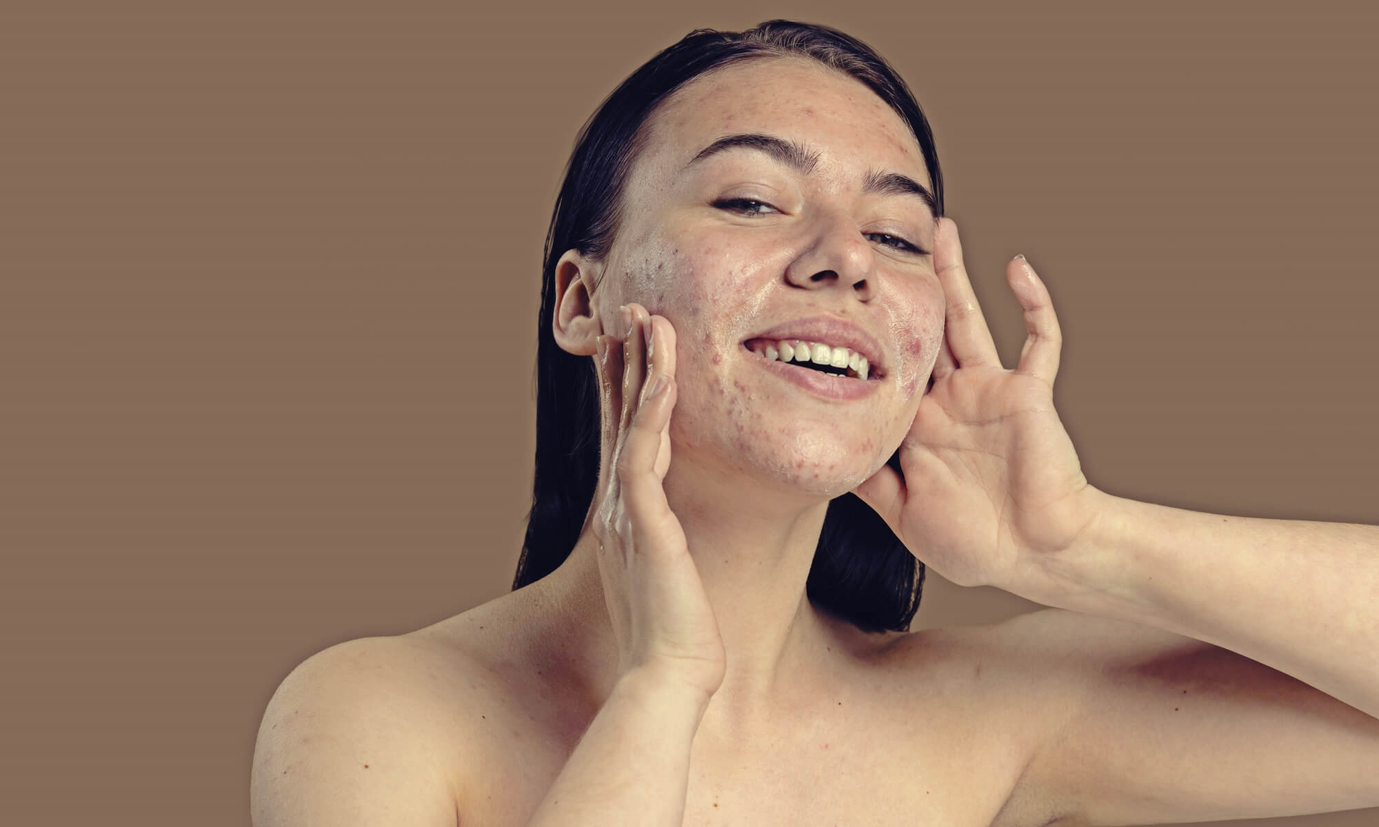 acneea tratament acnee dermatolog craiova medlink center leziuni acneice 1 acneea tratament acnee dermatolog craiova medlink center leziuni acneice 1