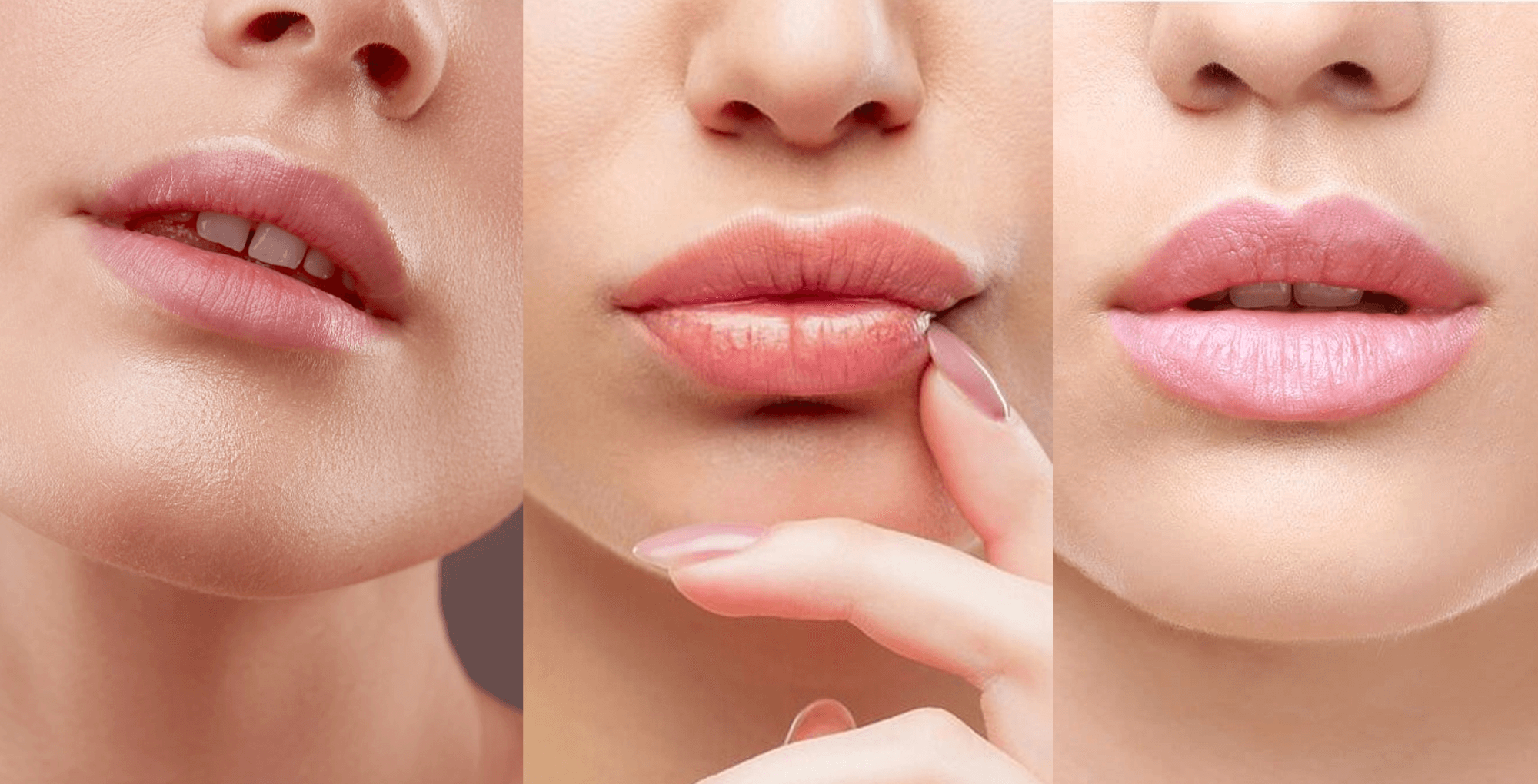 COVER volumizare buze acid hialuronic forme buze MedLink Center Craiova