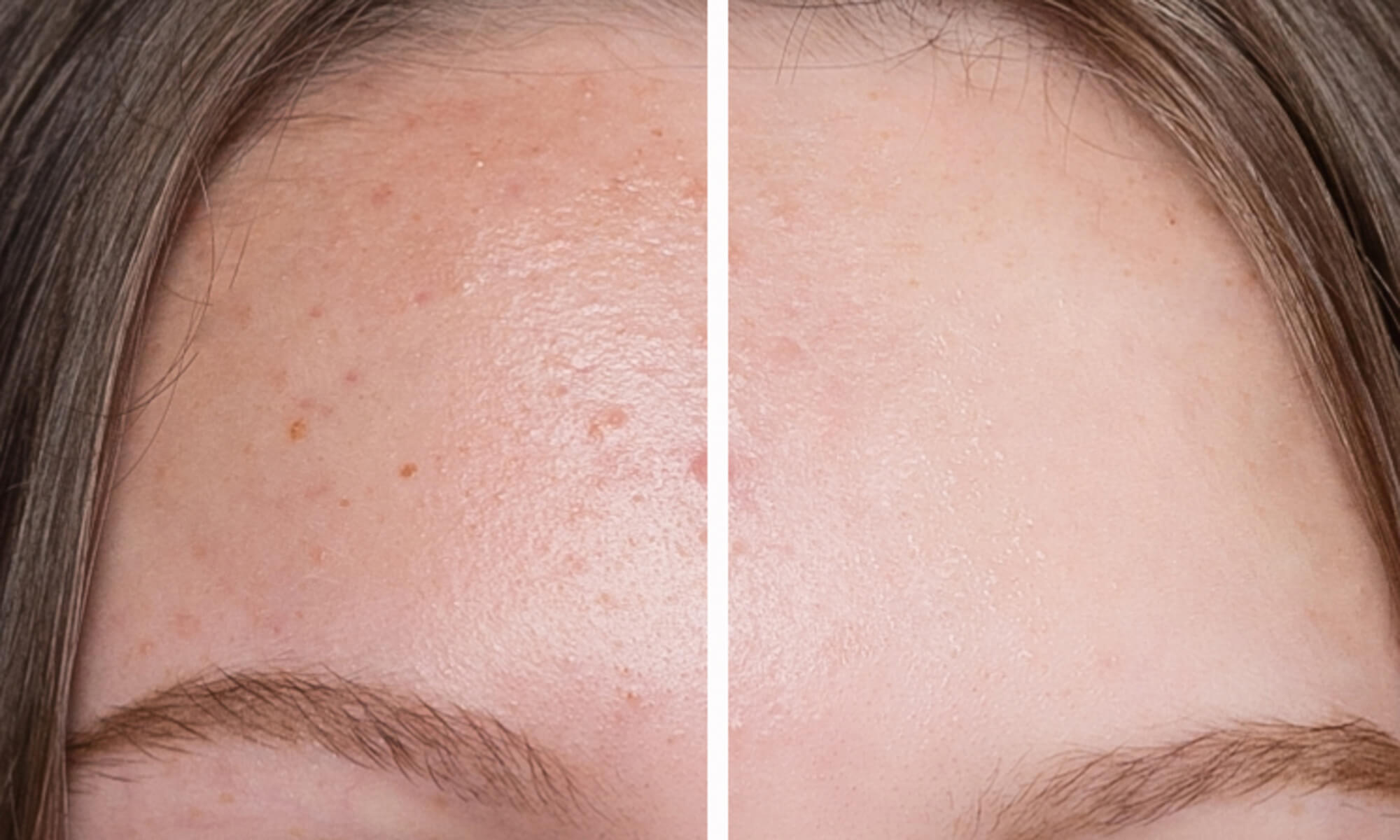 Ce afectiuni ale pielii dispar cu terapia vampir pentru fata