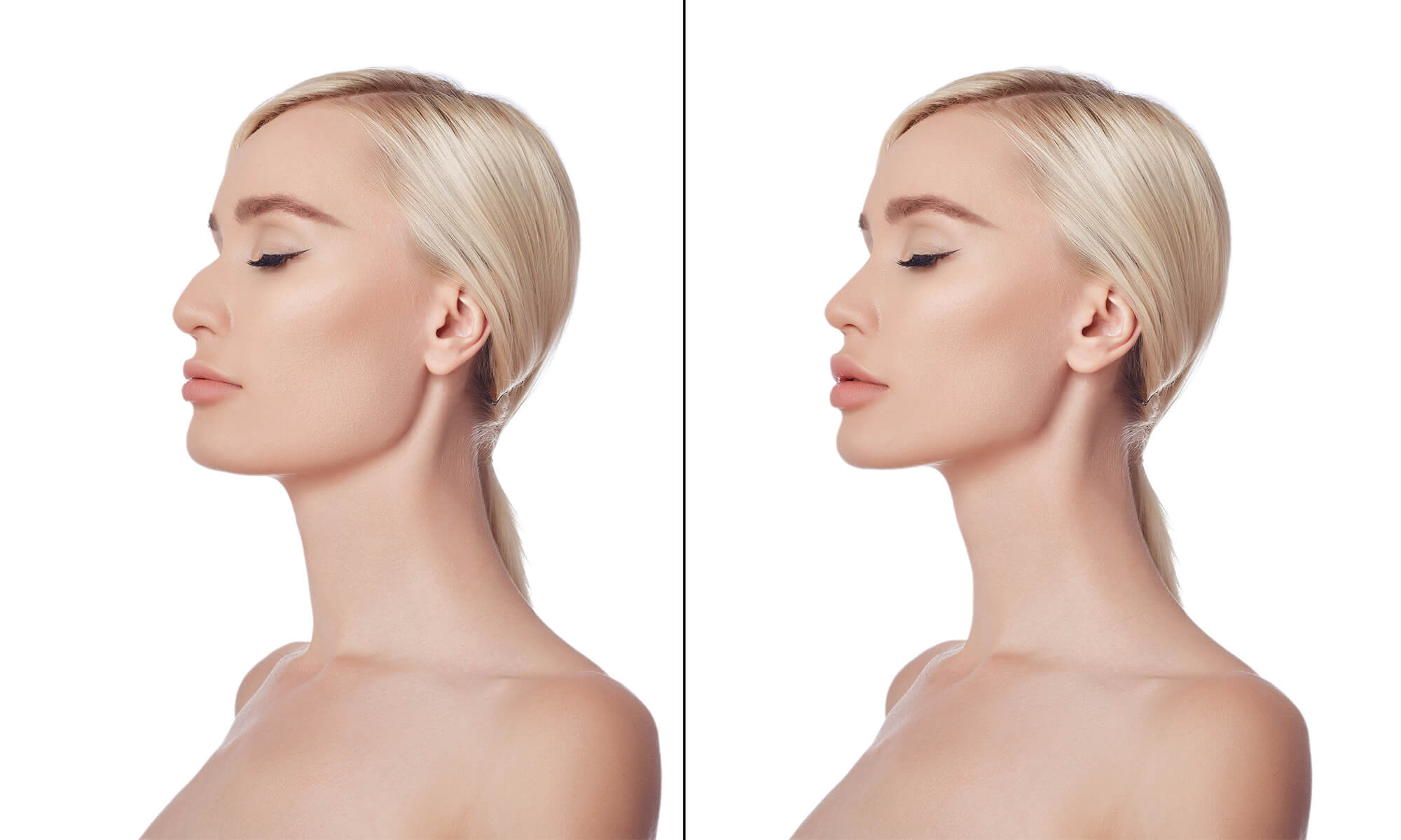 Tot ce ai nevoie să știi despre remodelare facială cu acid hialuronic