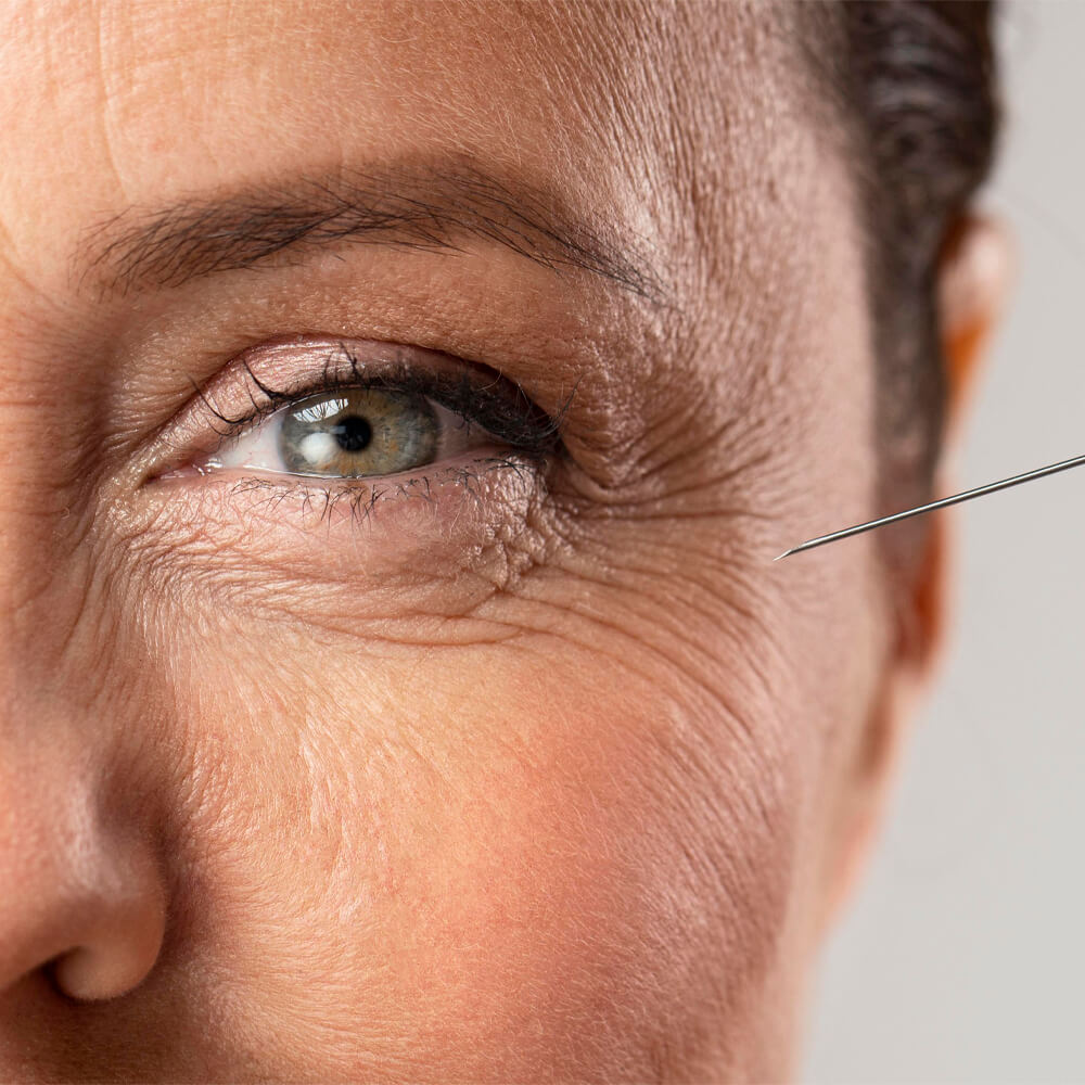 tratament riduri cearcane main page medlink