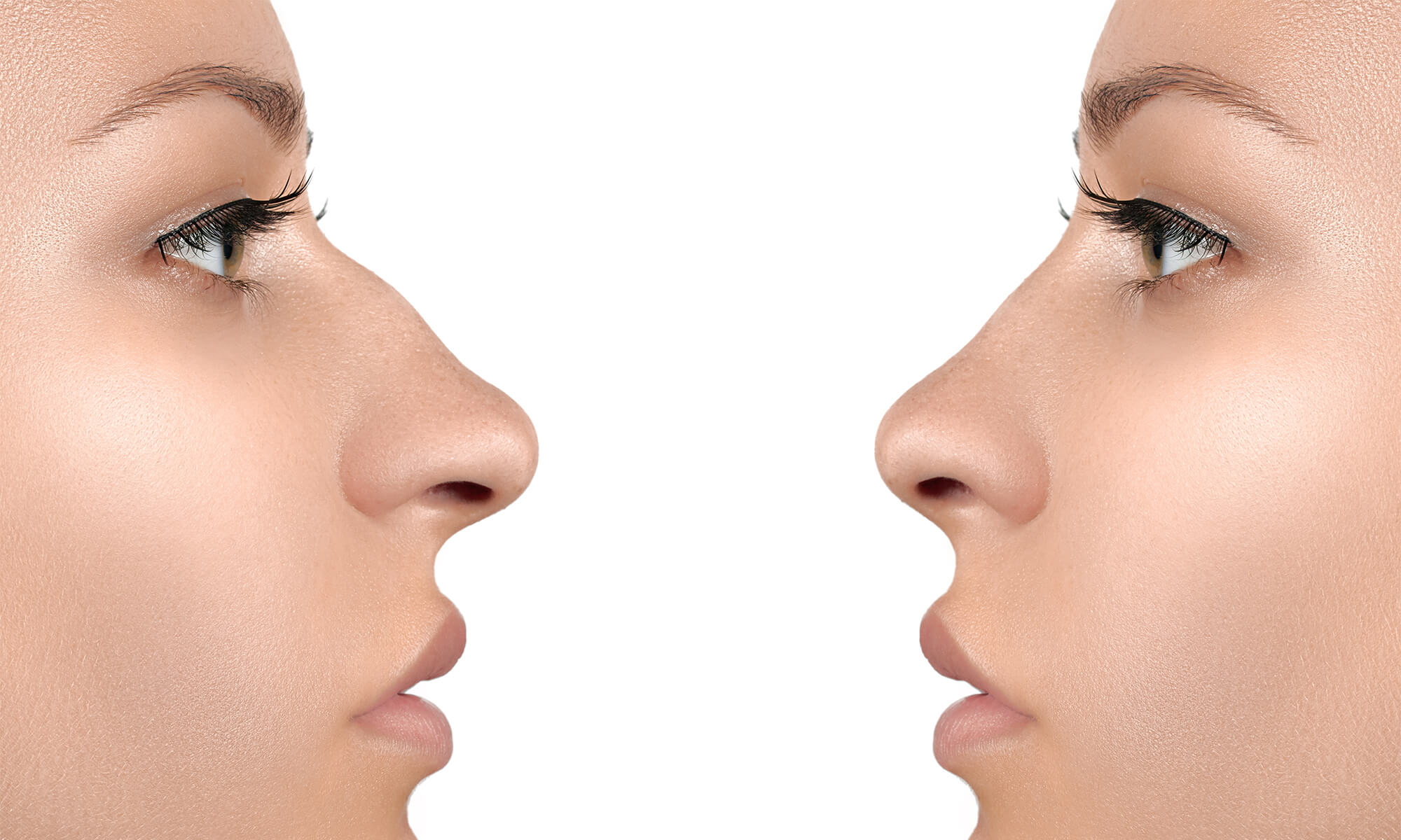 Uite cum diferă o rinocorecție cu acid hialuronic de cea chirurgicală