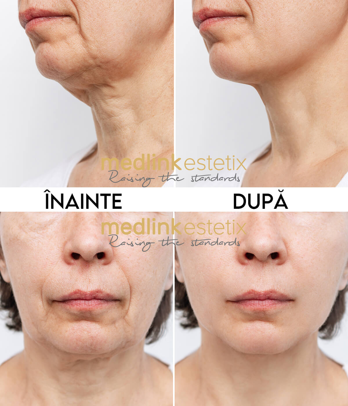 liniile gatului inainte dupa medlink 2