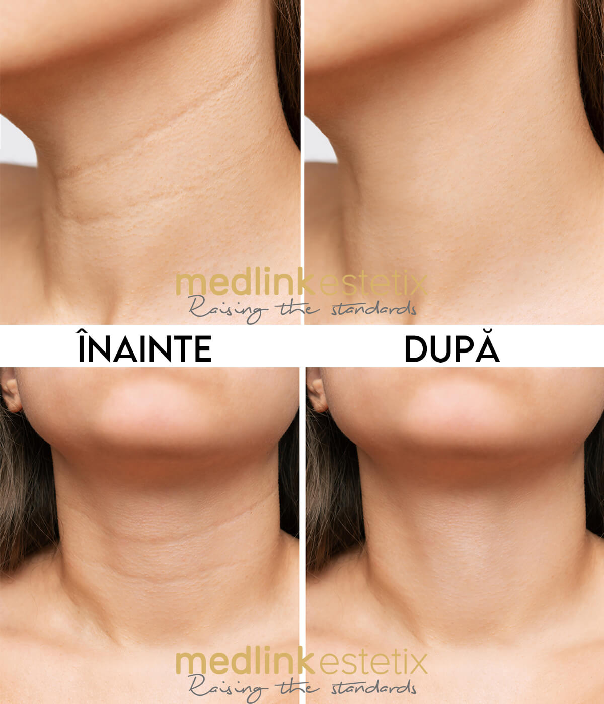 liniile gatului inainte dupa medlink