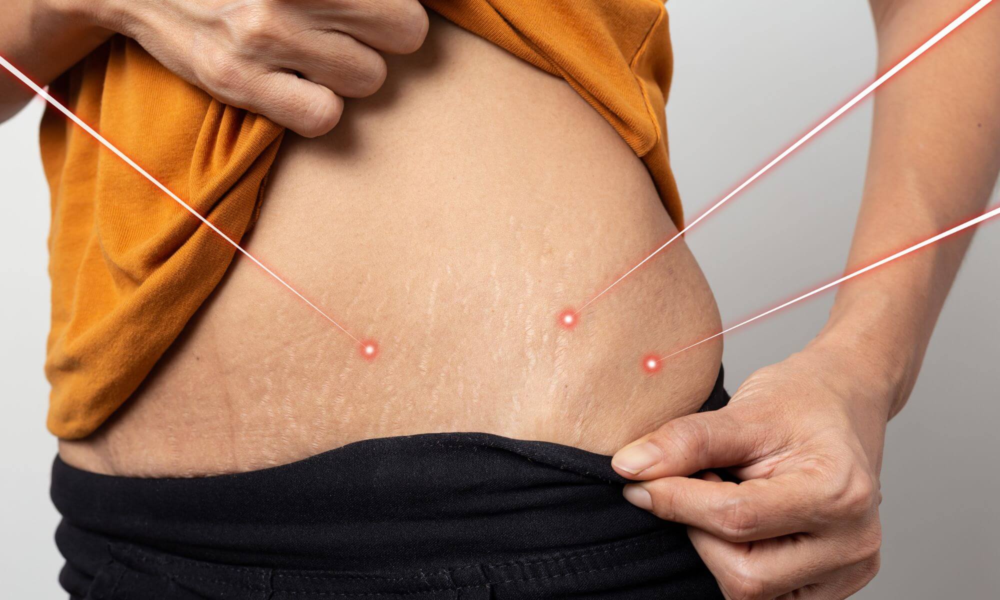 5 tipuri de tratament pentru vergeturi albe facute in cabinetul medical