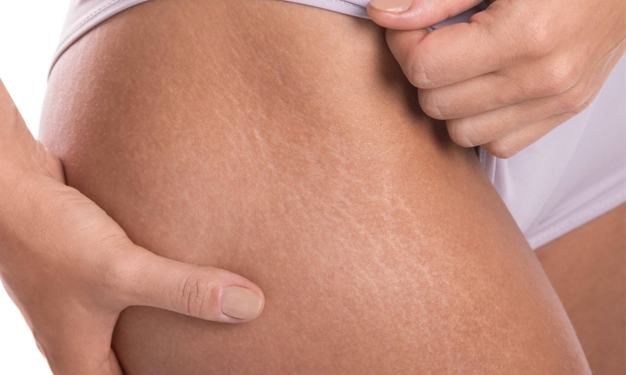 Ce sunt vergeturile si cum le poti trata imediat ce apar