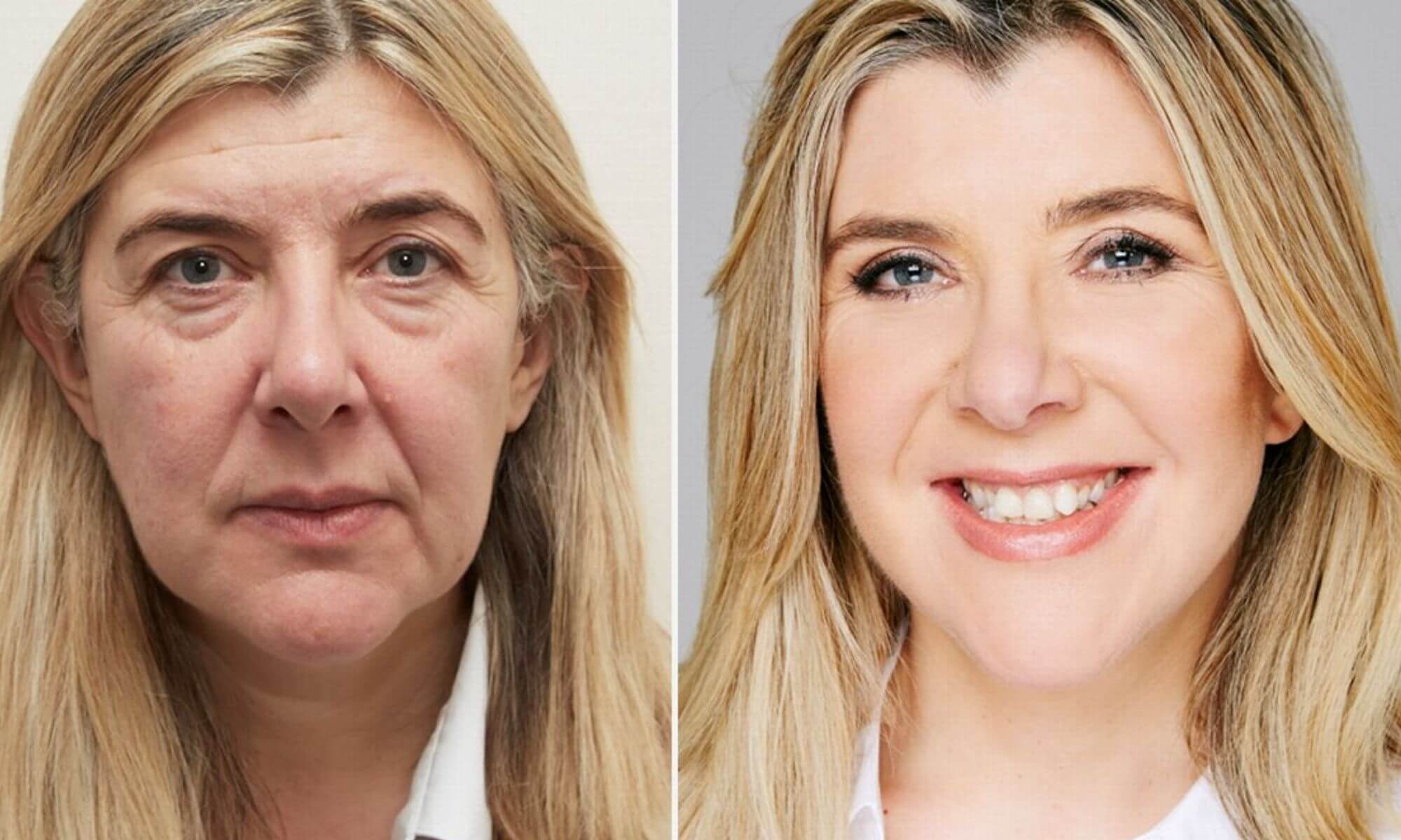 Cum sa arati cu 10 ani mai tanara fara lifting facial