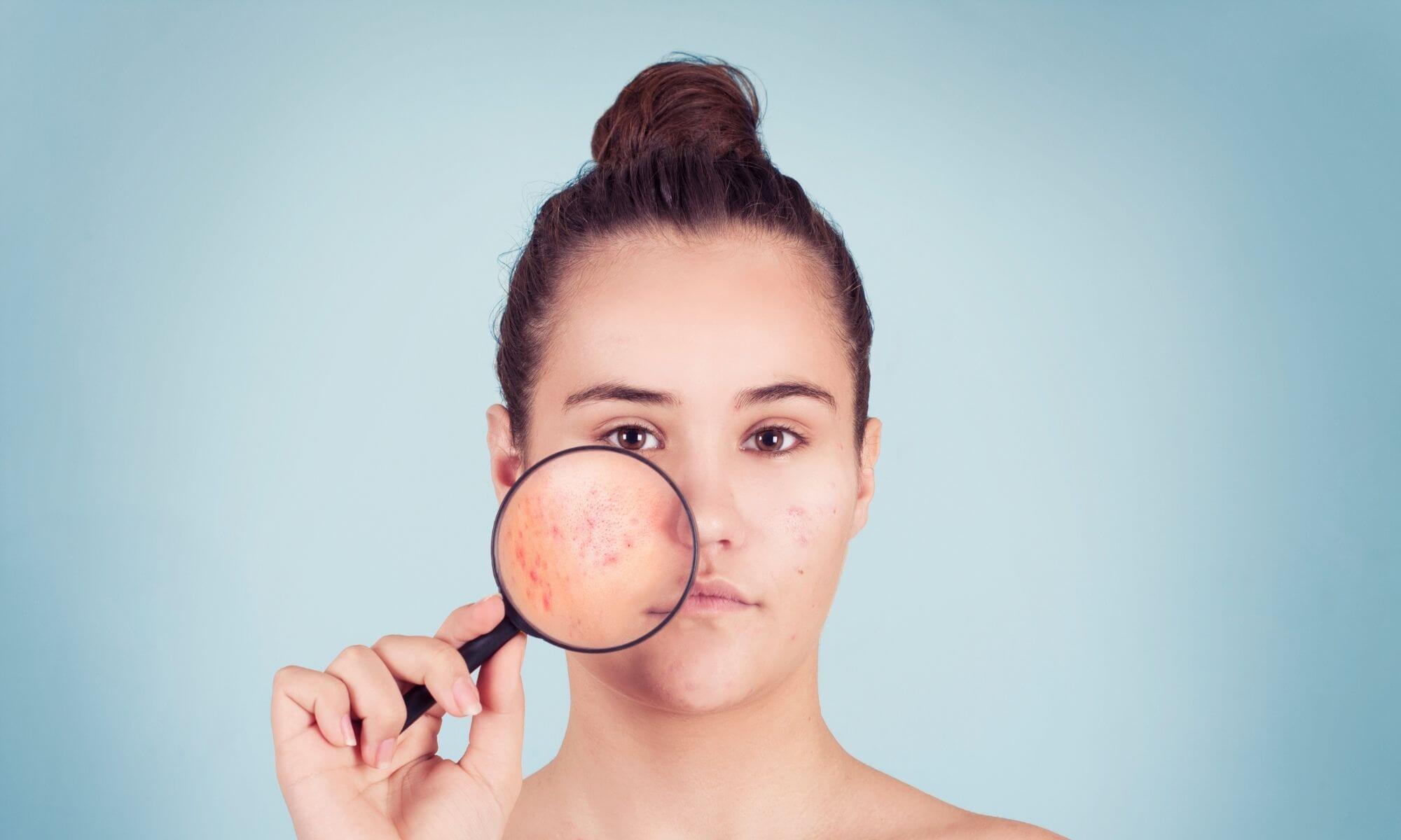 Tratamente pentru acneea de orice tip recomandate de medici