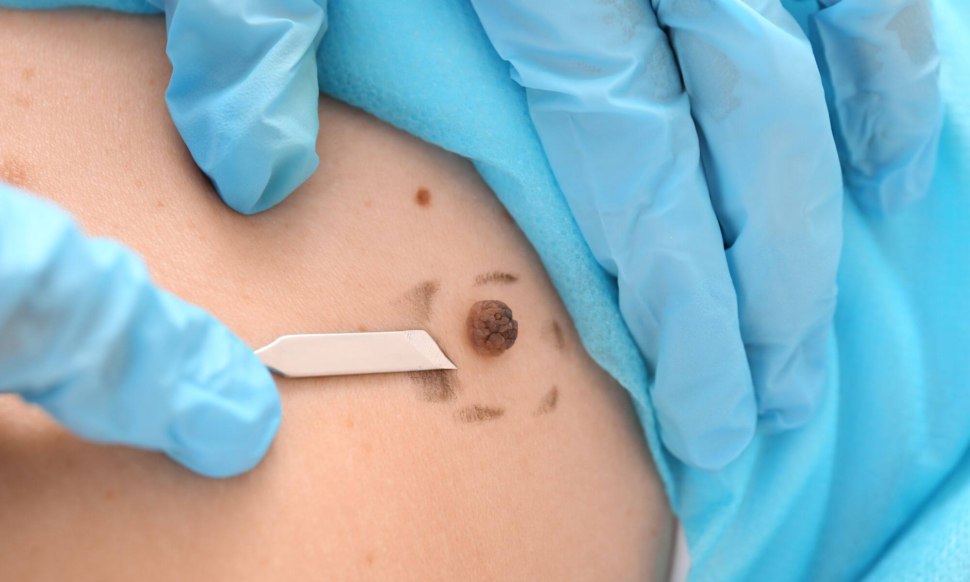 Alunita scoasa chirurgical Cand cum si de ce