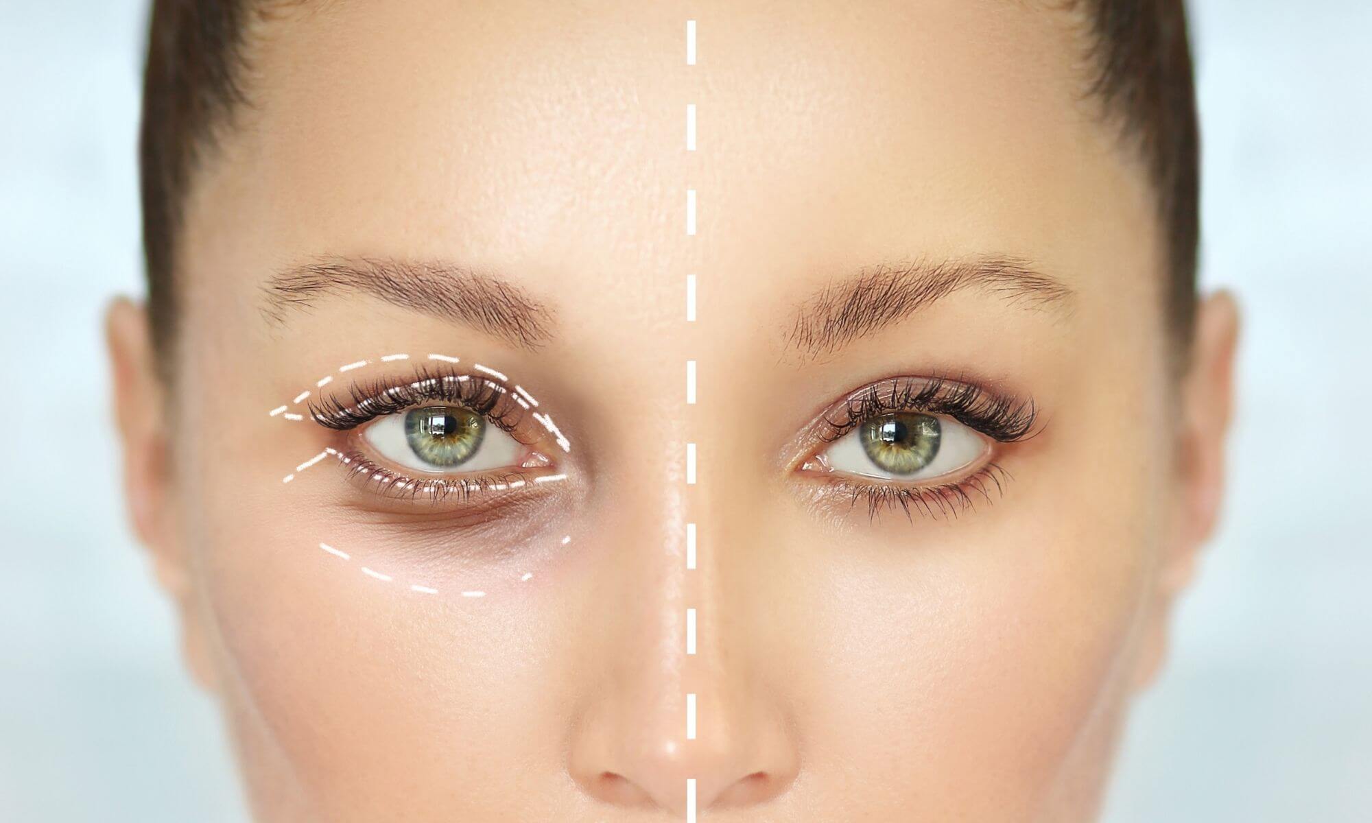 Inainte si dupa o blefaroplastie schimbarea uimitoare a 9 pacienti