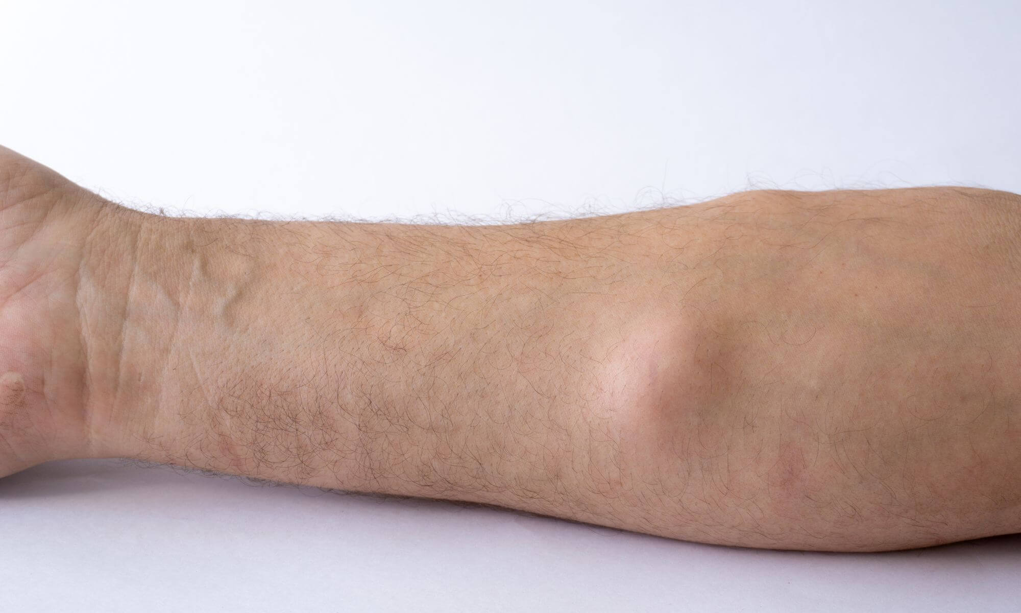 Operatie de lipom de grasime 5 intrebari la care cauti raspuns