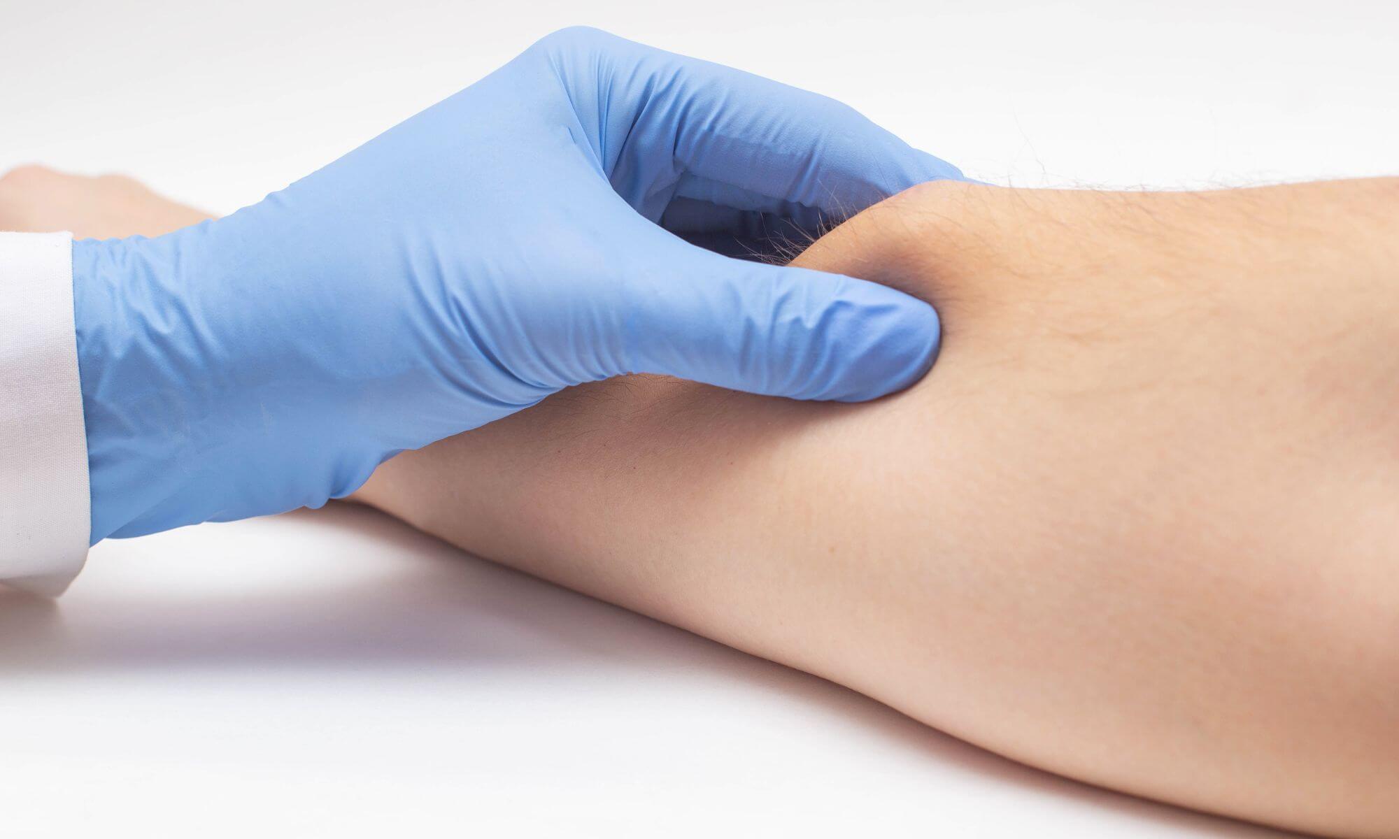 3 tipuri de tratament pentru lipom ce nu lasa cicatrici