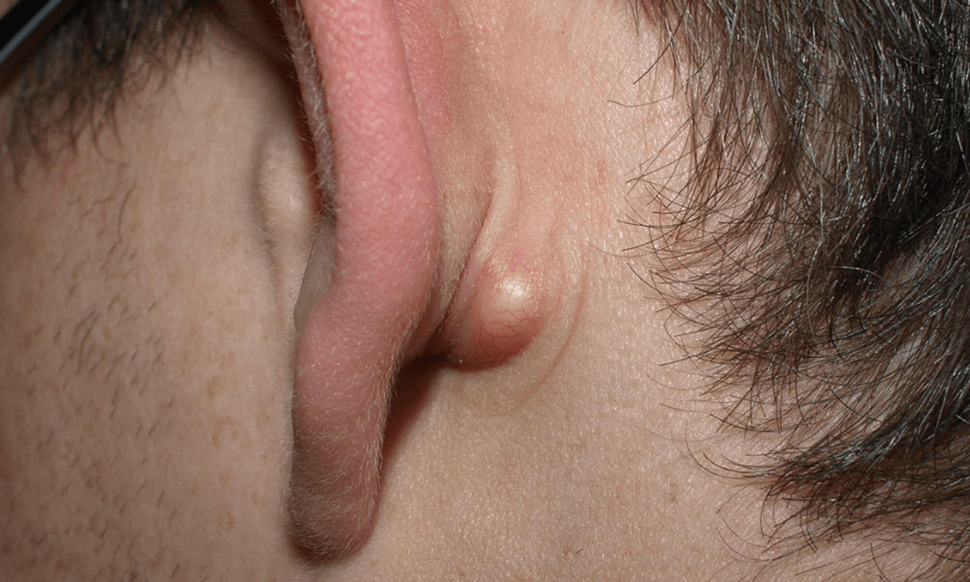 Te ingrijoreaza aparitia unui chist sebaceu la ureche