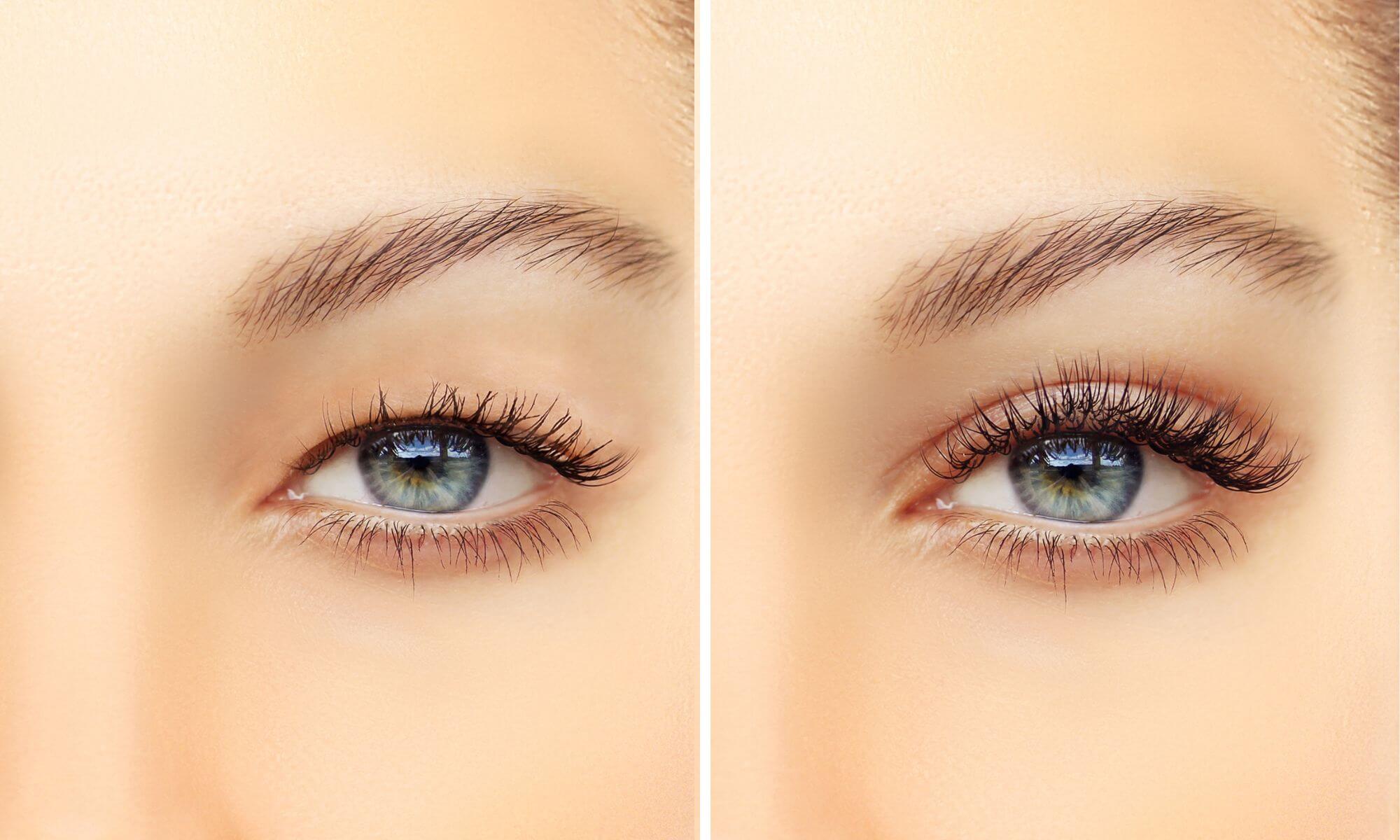 Cat dureaza sa arati bine dupa o blefaroplastie superioara