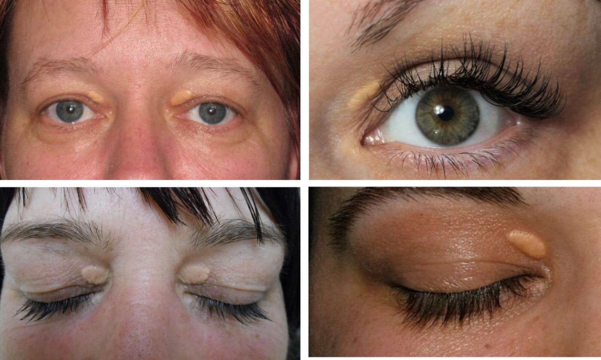 De ce sa faci o operatie de xantelasma cat inca are dimensiuni mici 1