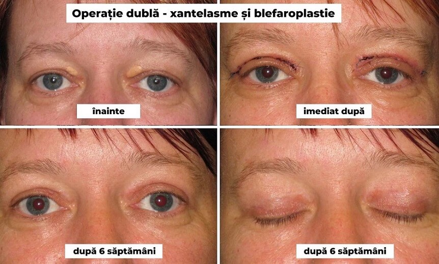 Operatie dubla - xantelasme si blefaroplastie