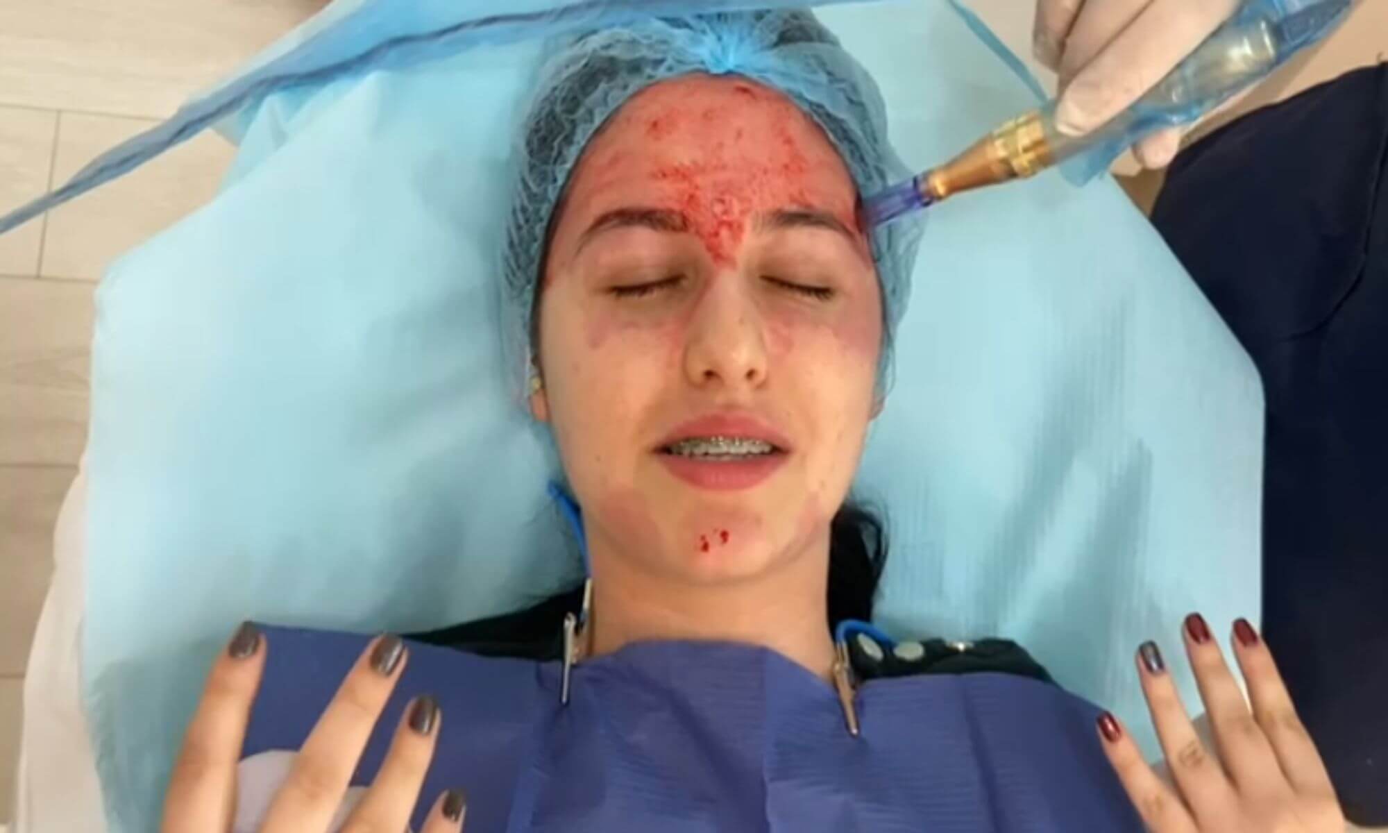 Terapia Vampir pareri si foto inainte si dupa