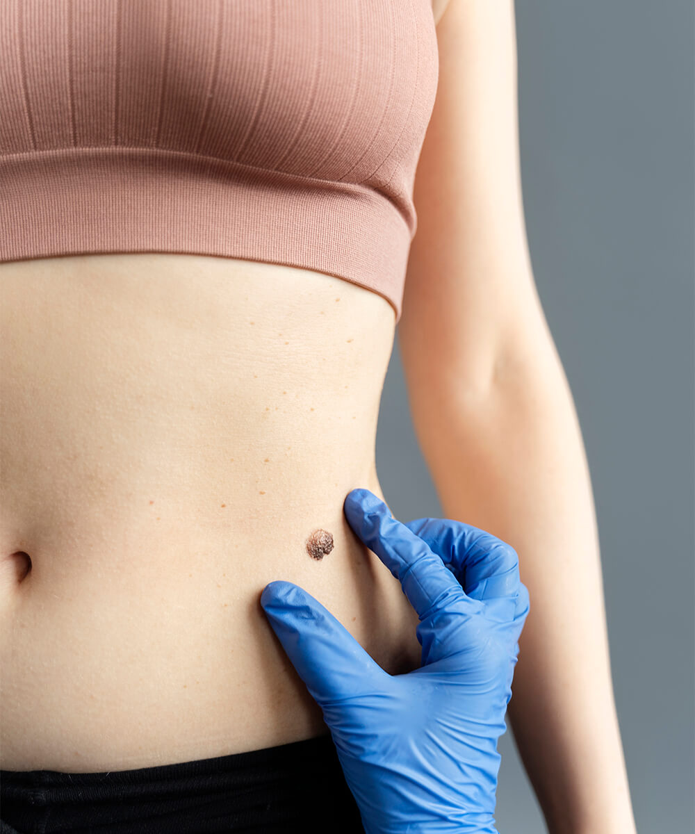 caracteristici nev pigmentar