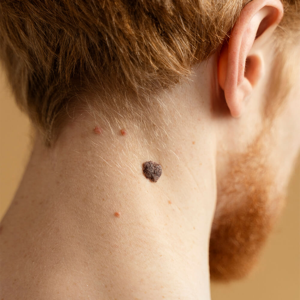 nev pigmentar main page medlink