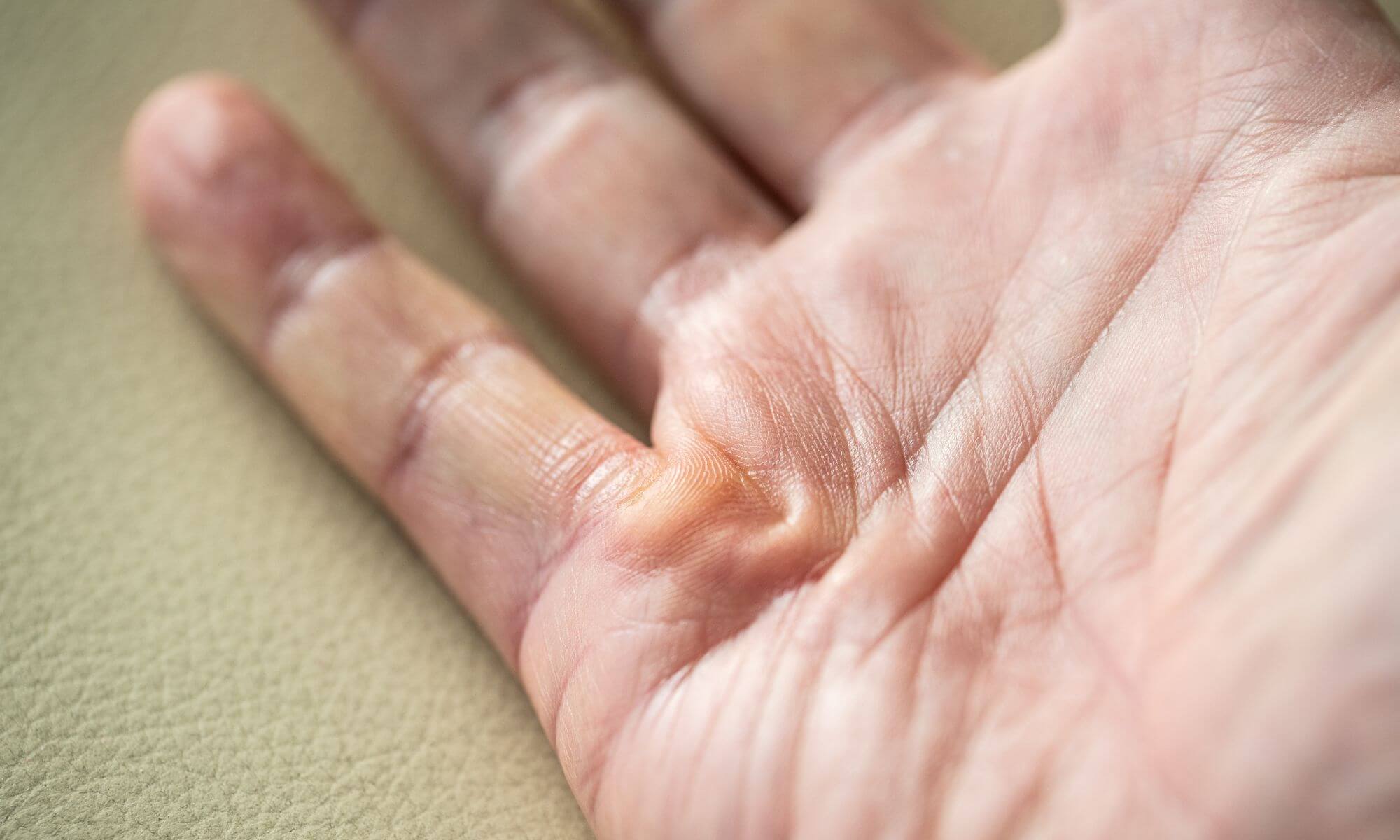 Ce tratament pentru Dupuytren este potrivit in diverse stadii ale bolii