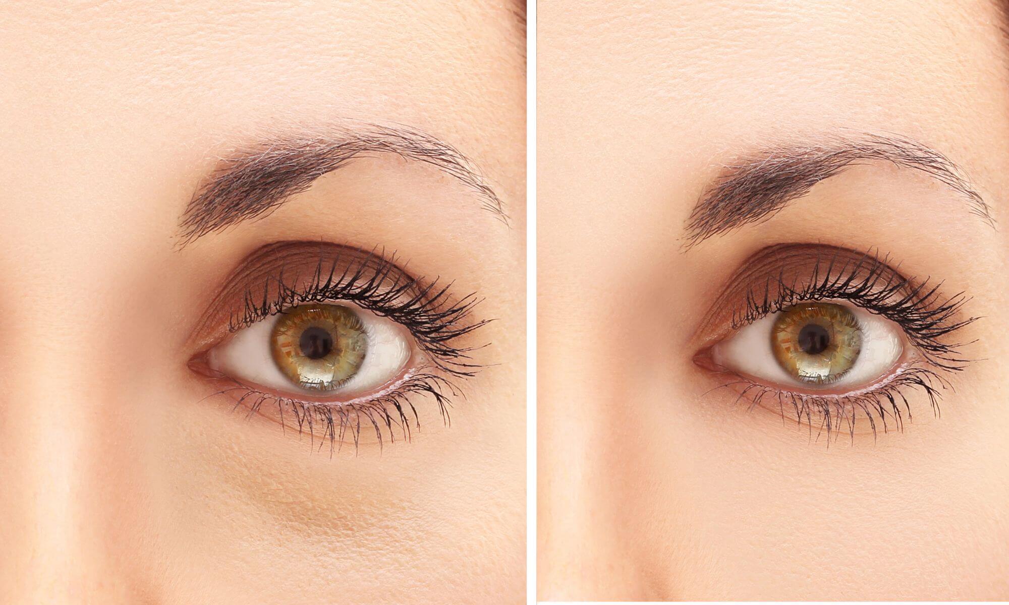 Foto inainte si dupa o blefaroplastie la pleoapa inferioara 1