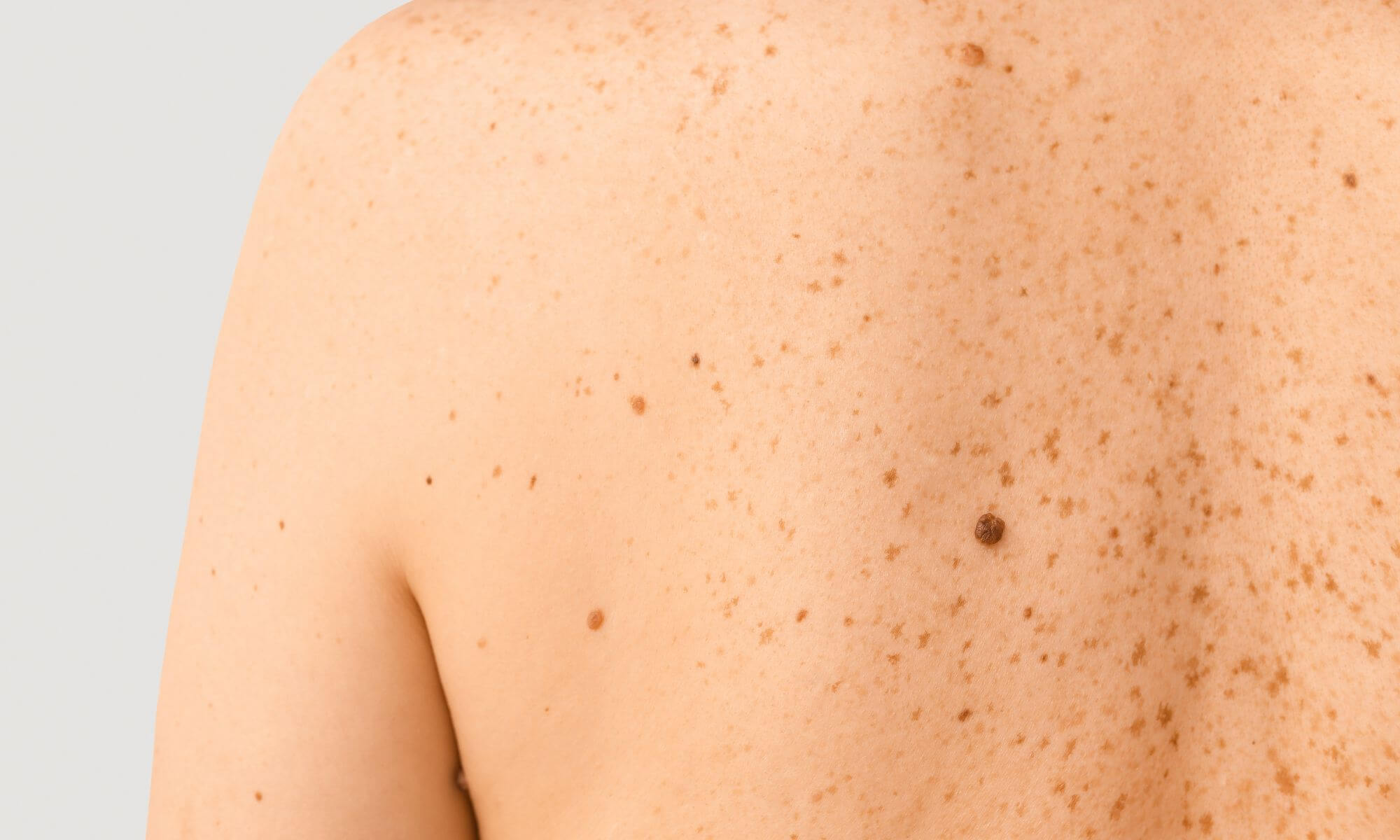 Adevarul despre scoatere alunite cu metode moderne