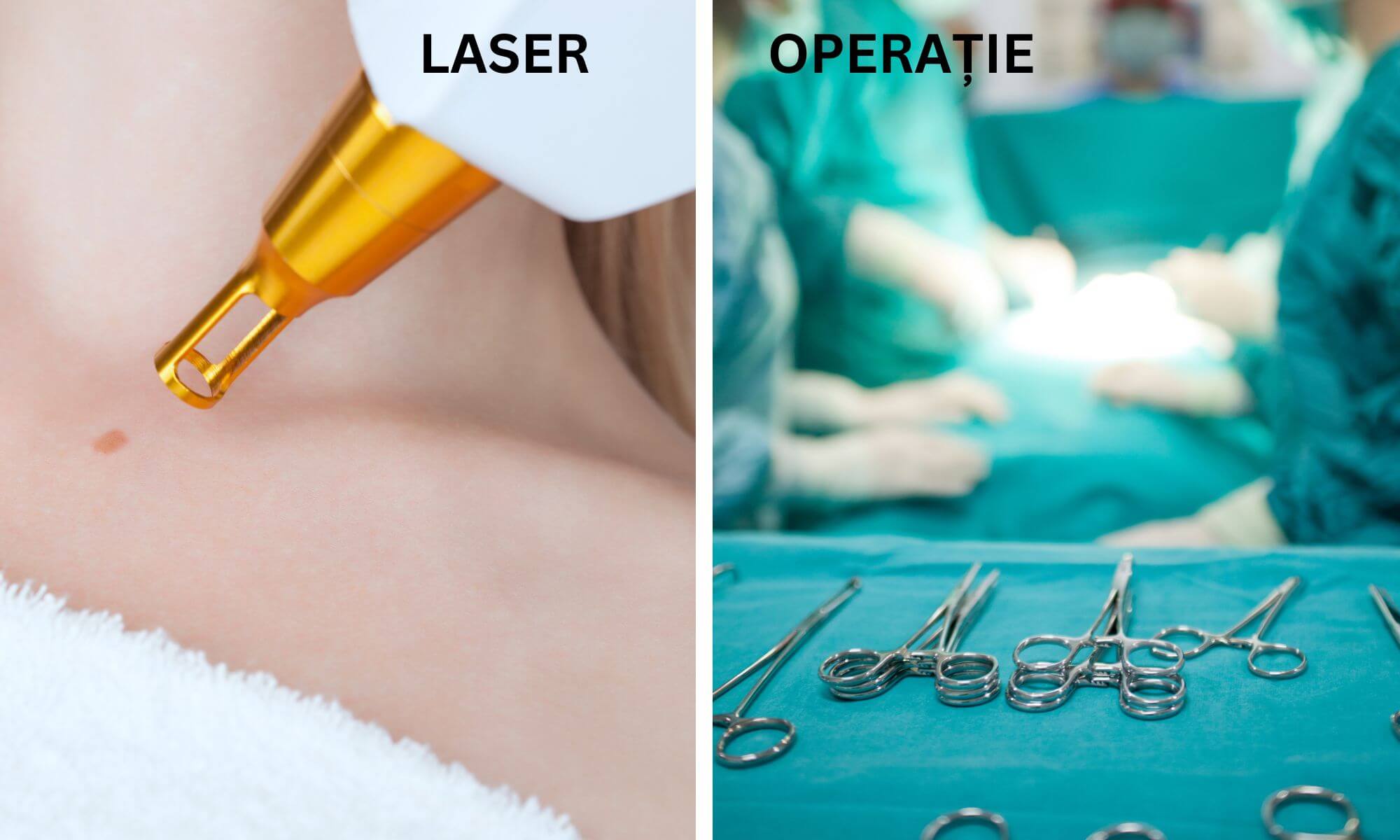 Ce dezavantaje are o operatie de scoatere alunite fata de metoda laser