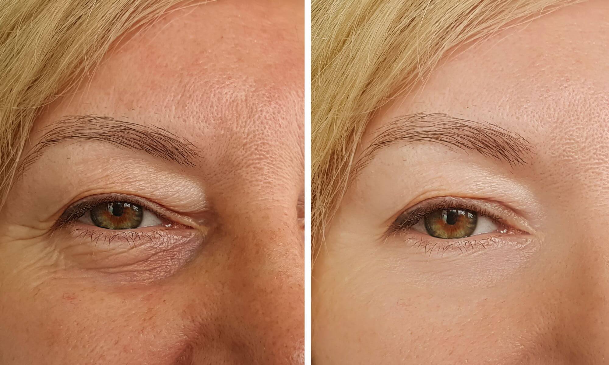 Minciunile despre riduri ochi intretinute de industria cosmetica