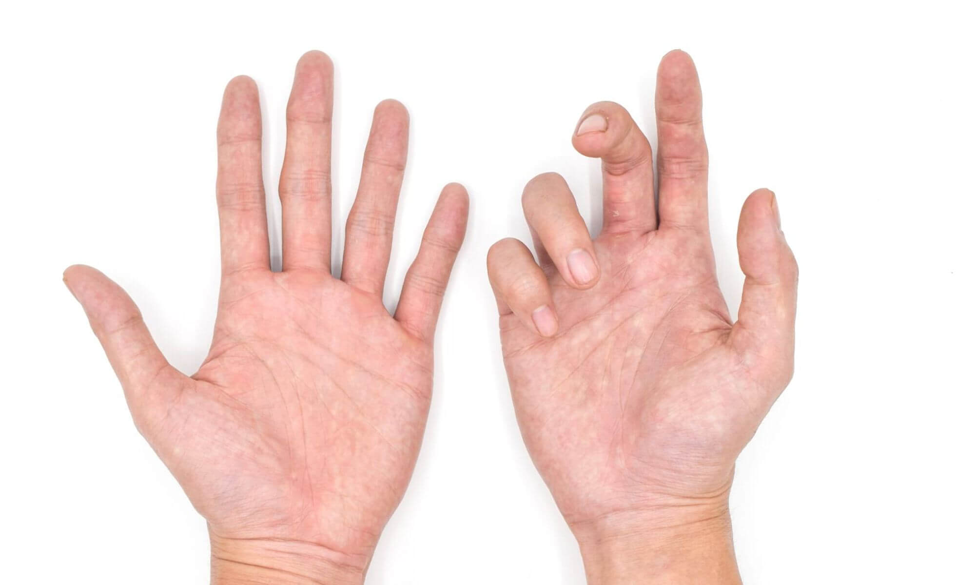 Boala Dupuytren ii afecteaza pe cei dragi