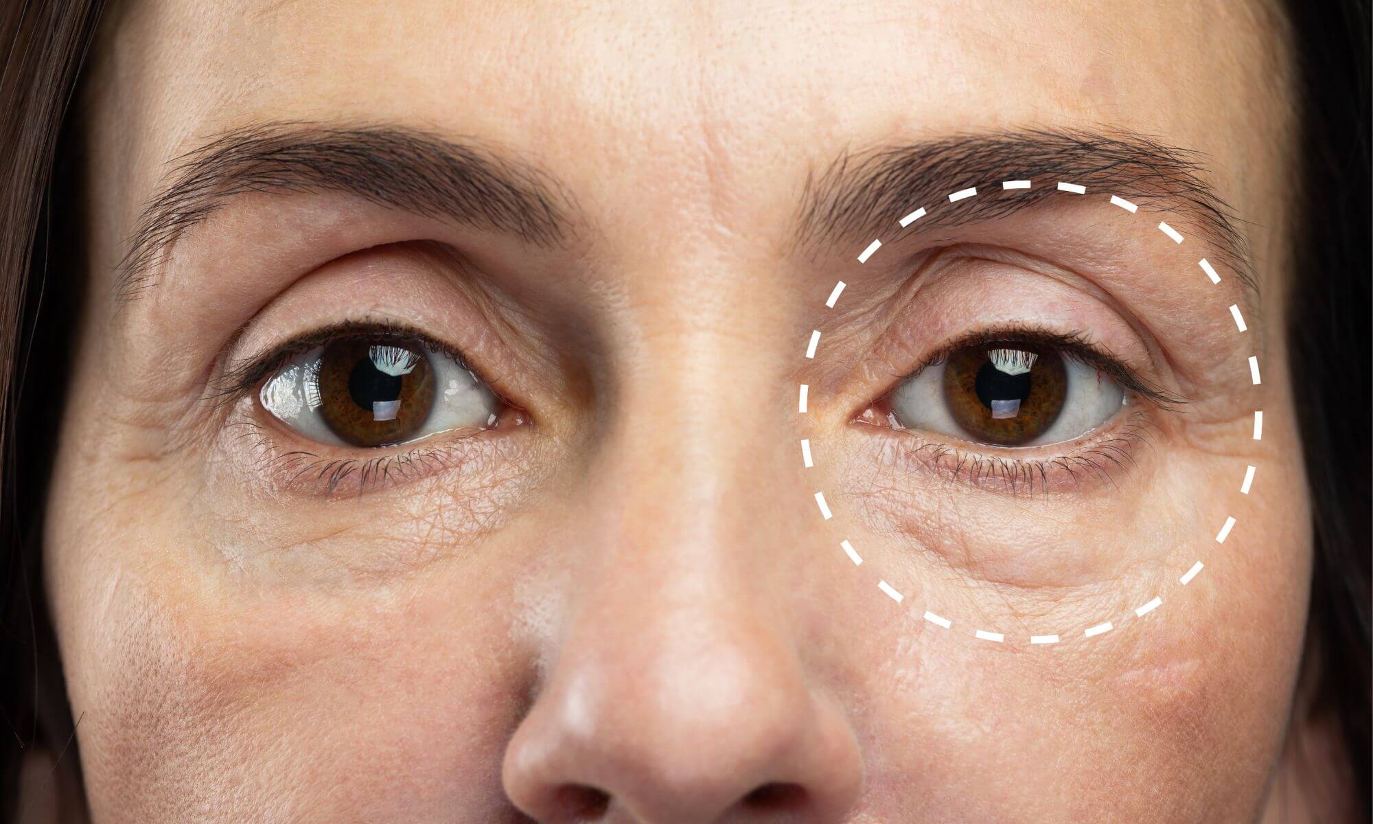 Ce este blefaroplastia operatia de intinerire a ochilor