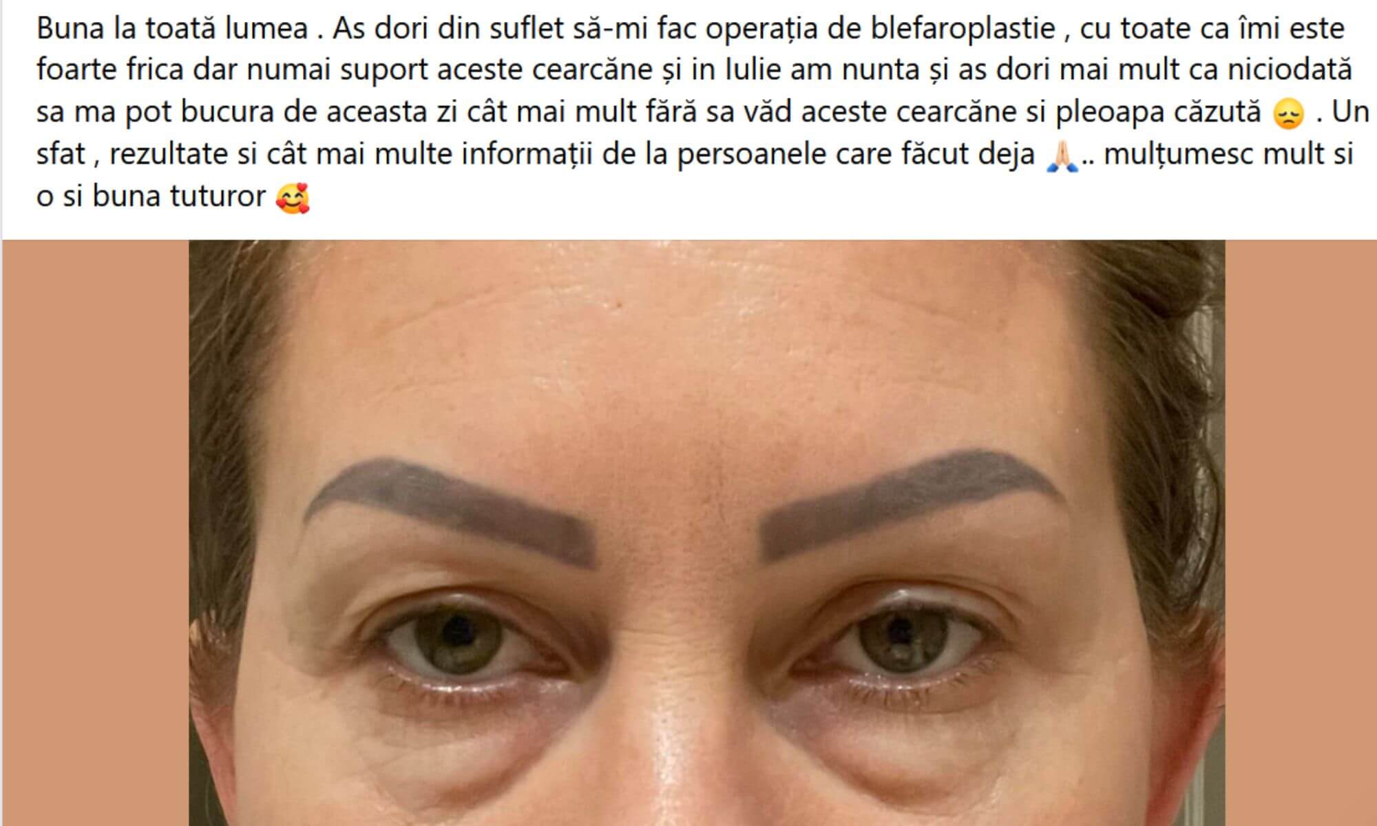 Necenzurat pareri despre operatia de blefaroplastie