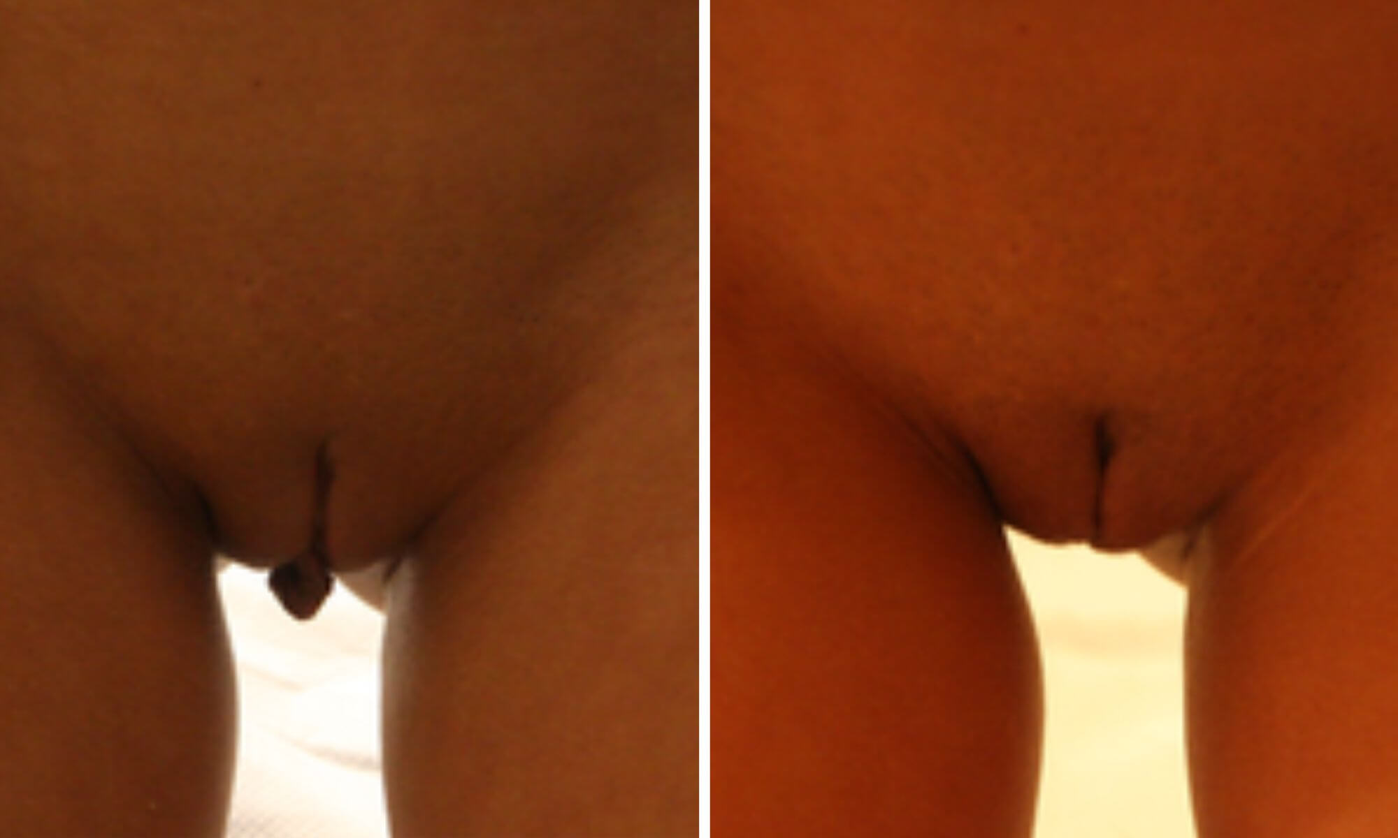 Pacienta 2 labioplastie