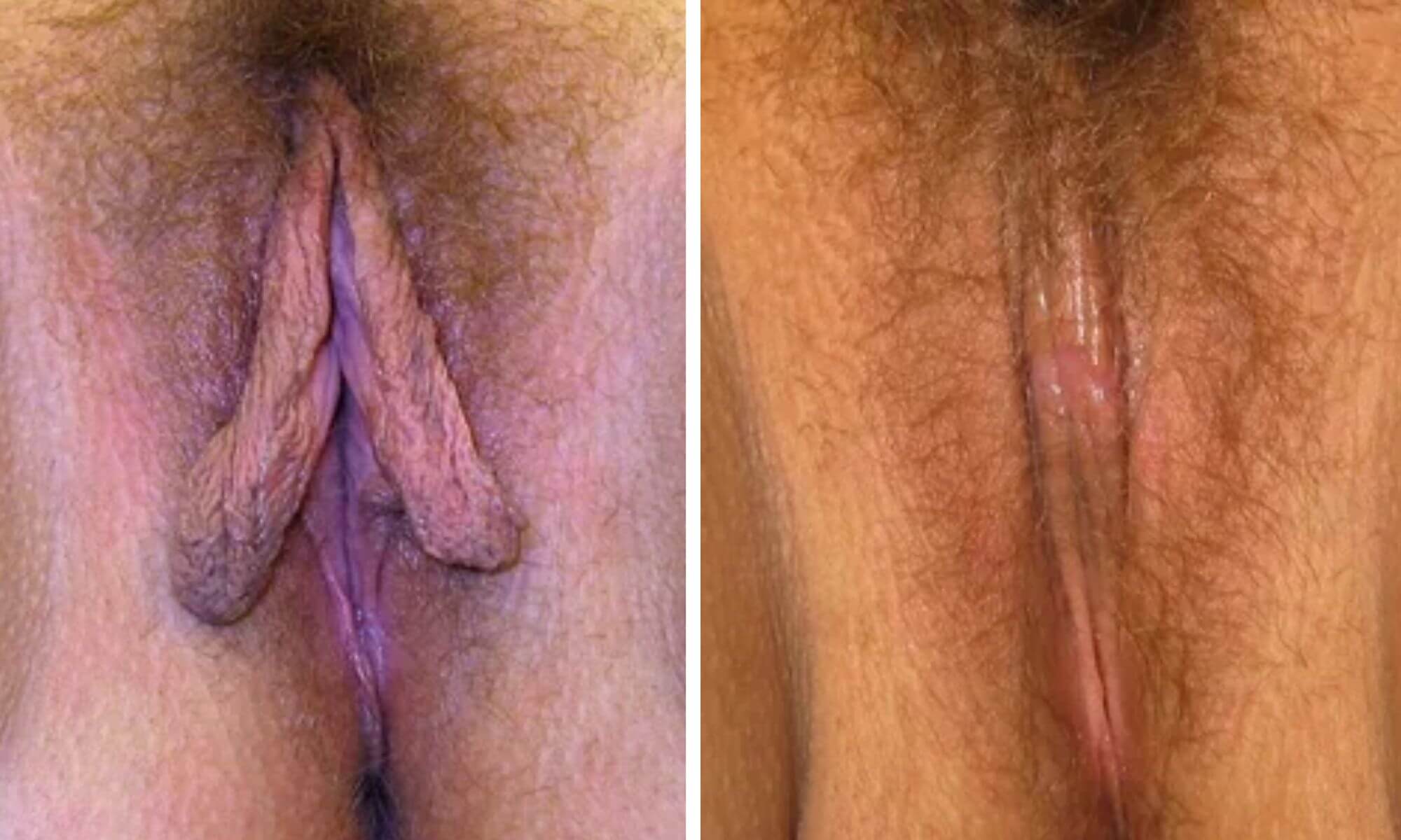 Pacienta 3 labioplastie