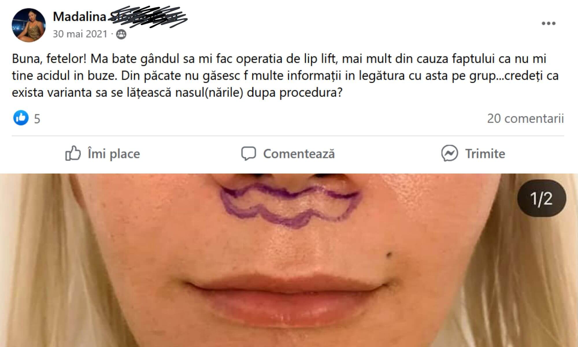 Pareri despre lifting buza superioara