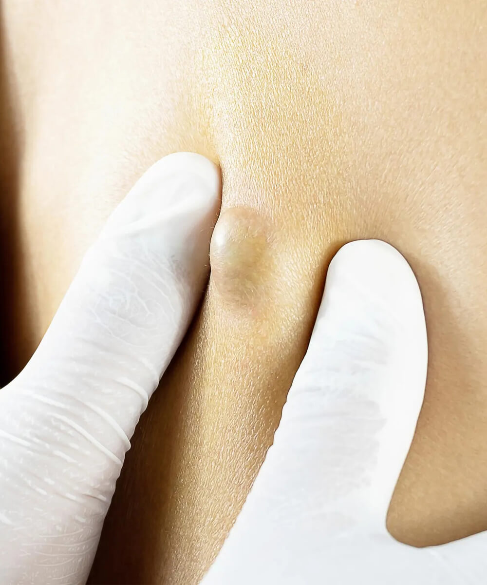 lipom chisturi sebacee caracteristici