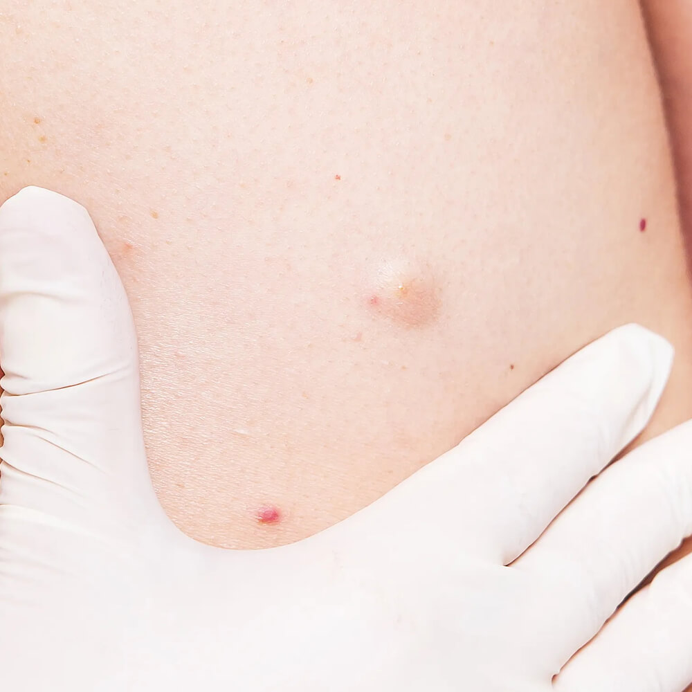 lipom chisturi sebacee main page medlink