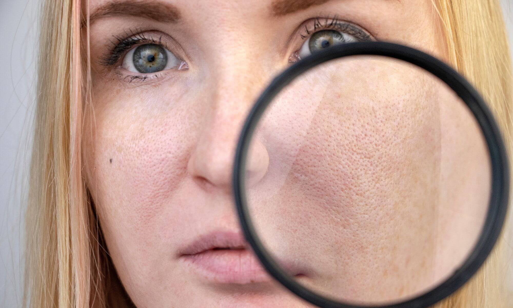 Acest tratament pentru pori dilatati le reduce dimensiunea cu peste 70