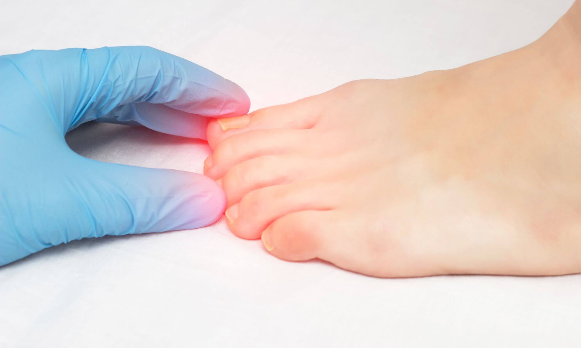 Cat de grav poate evolua o unghie incarnata si ce tratamente sunt eficace Cat de grav poate evolua o unghie incarnata si ce tratamente sunt eficace