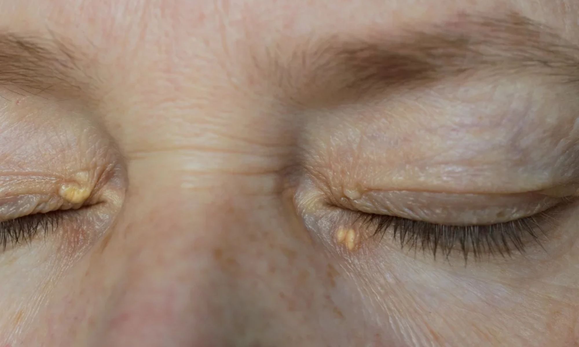 Ce sunt acele puncte de grasime pe pleoape si cum scapi de ele