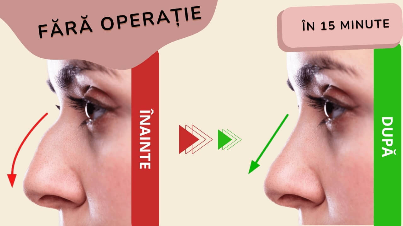 Nu esti pregatita sa faci operatie pentru nasul carn