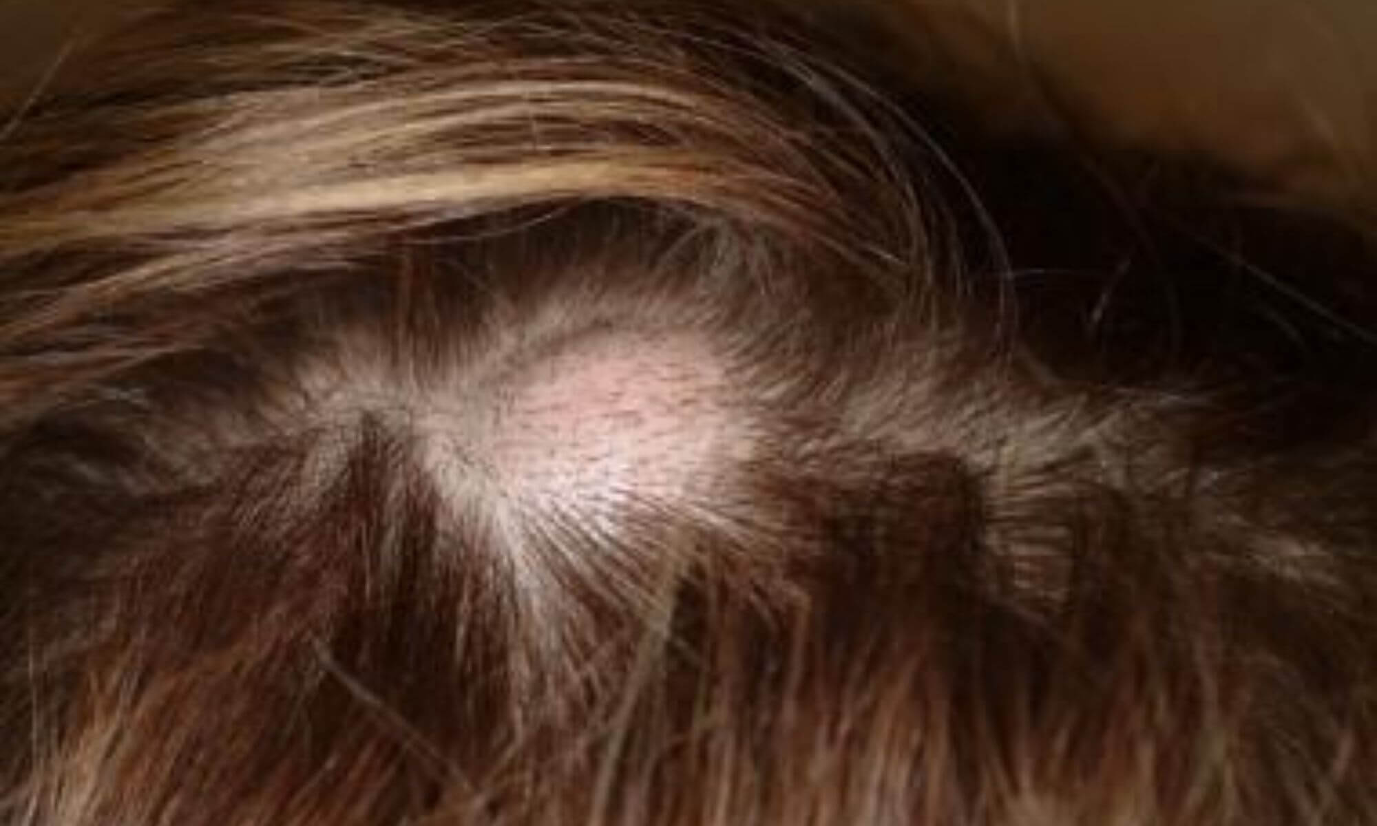 Nu face aceste greseli daca ai un chist sebaceu pe scalp