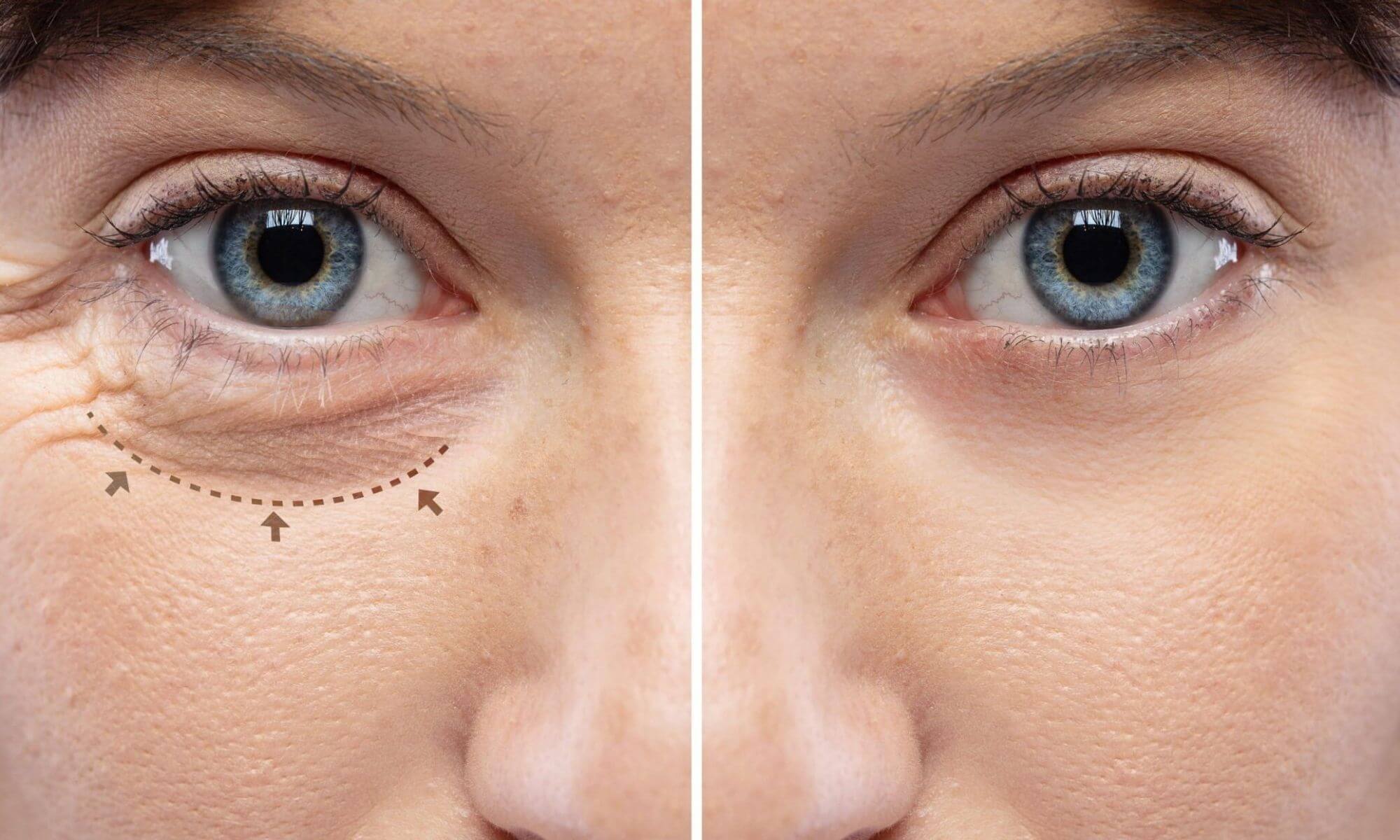 4 alternative de blefaroplastie nechirurgicala cu plusuri si minusuri