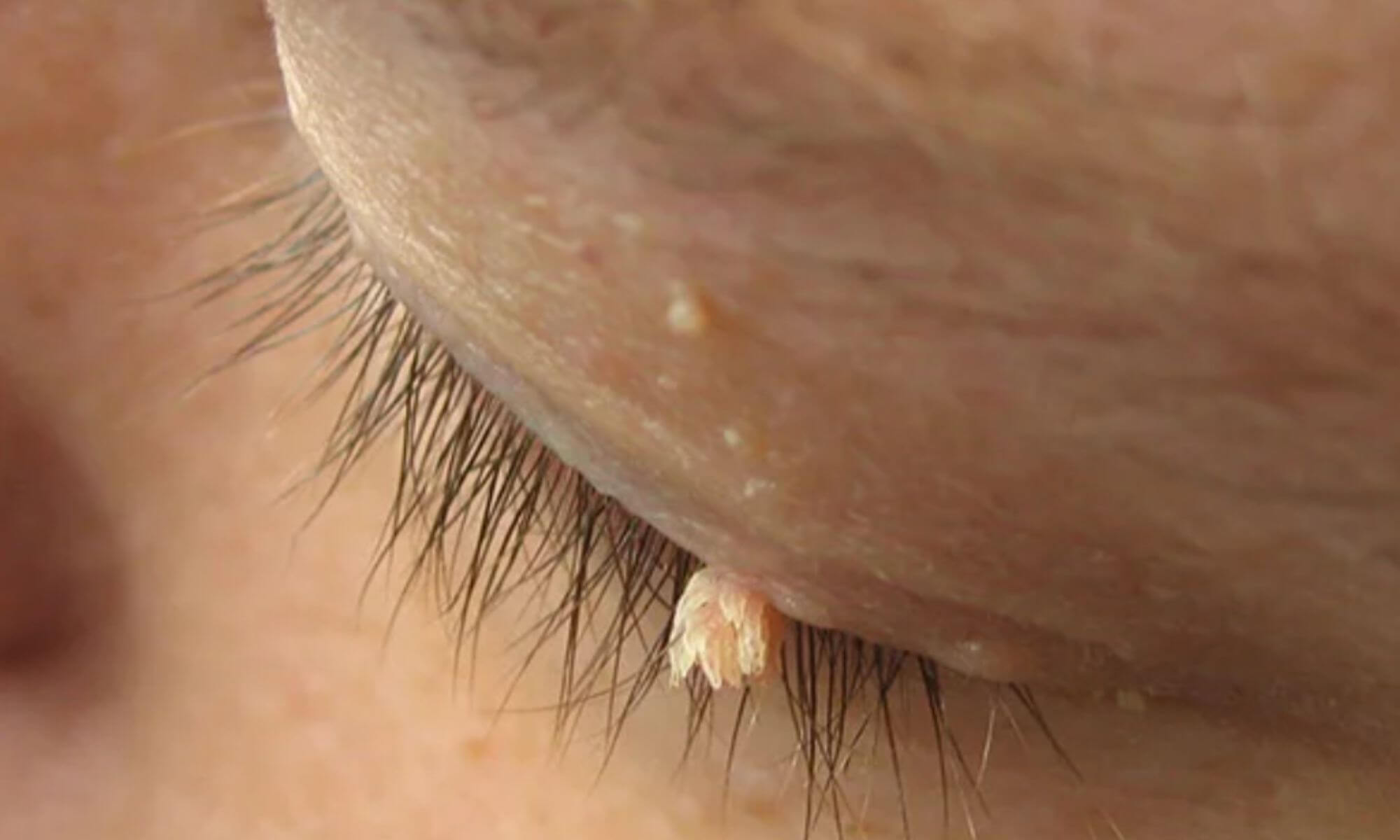 5 tipuri de tratament pentru veruci filiforme 5 tipuri de tratament pentru veruci filiforme