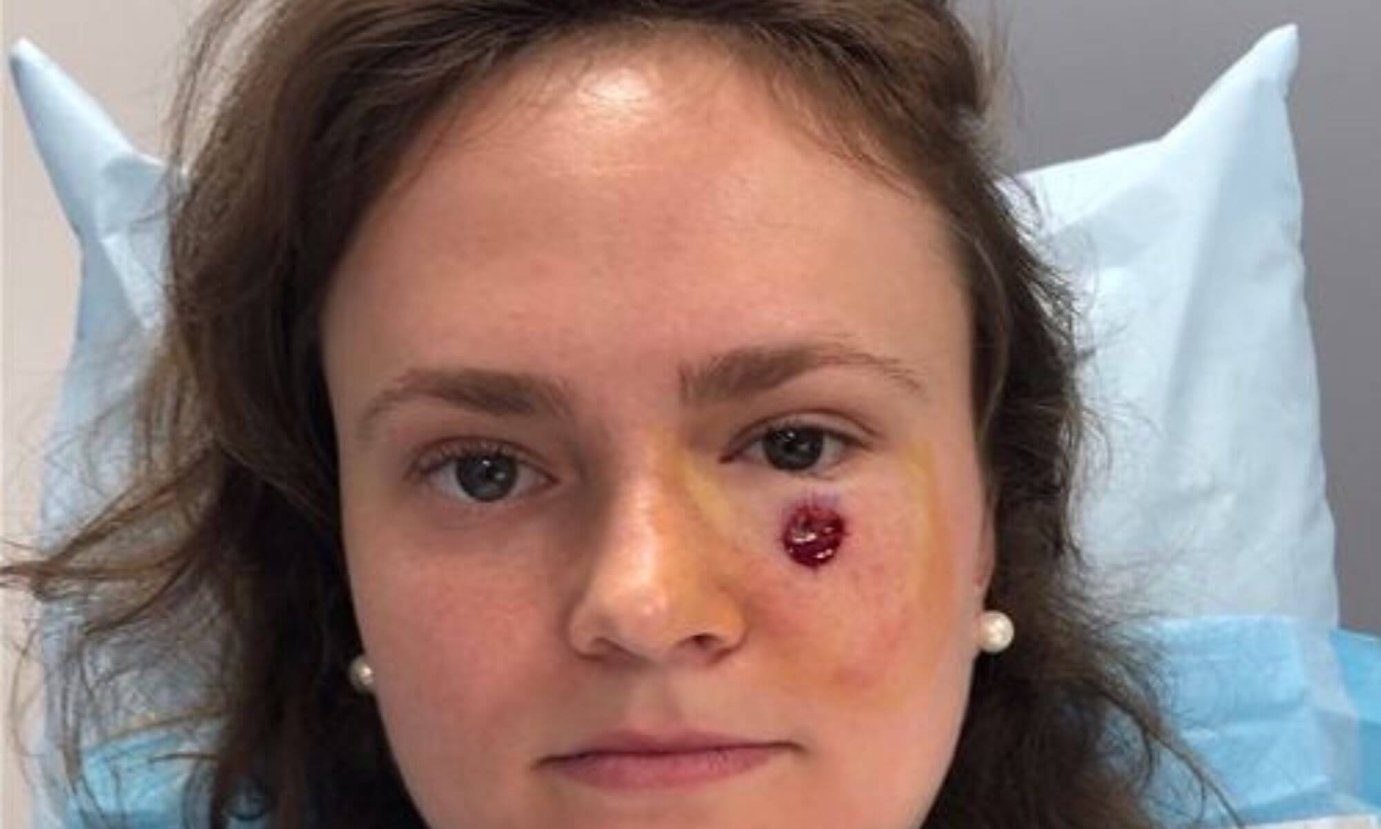 Cand un cos se dovedeste a fi cancer de piele