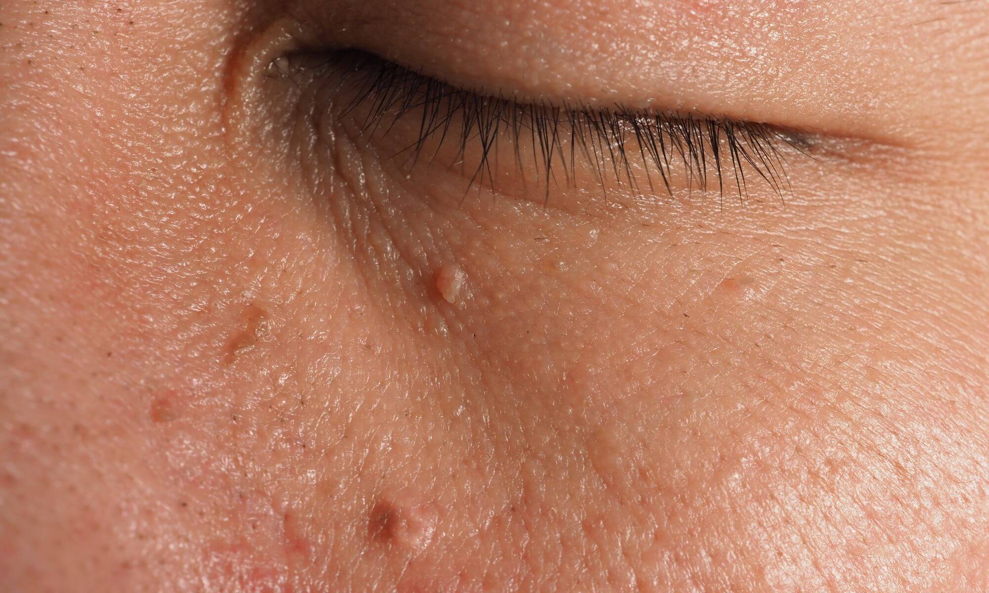 Carcinom bazocelular cel mai frecvent tip de cancer de piele foto