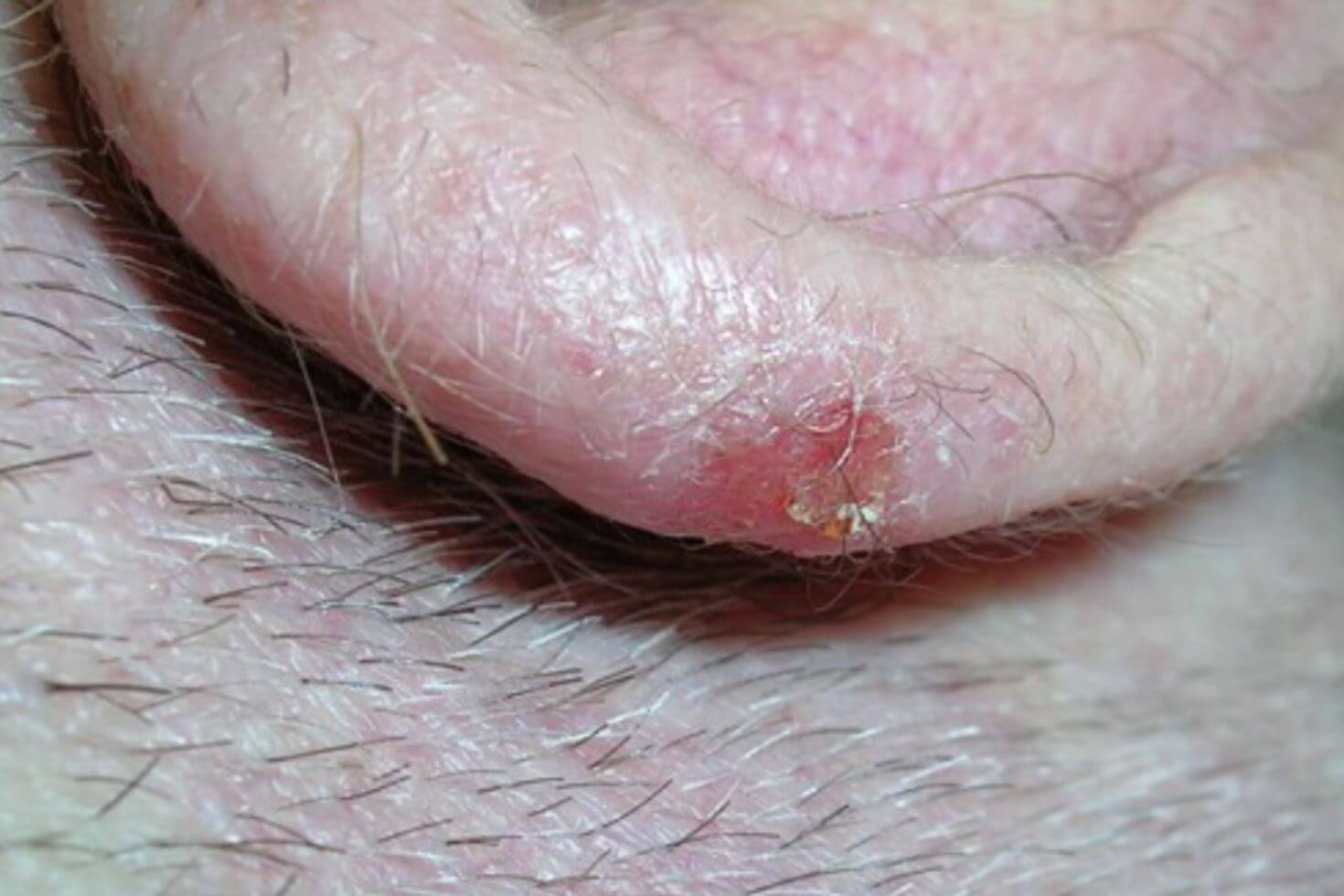 Carcinom cutanat spinocelular 2 Carcinom cutanat spinocelular 2